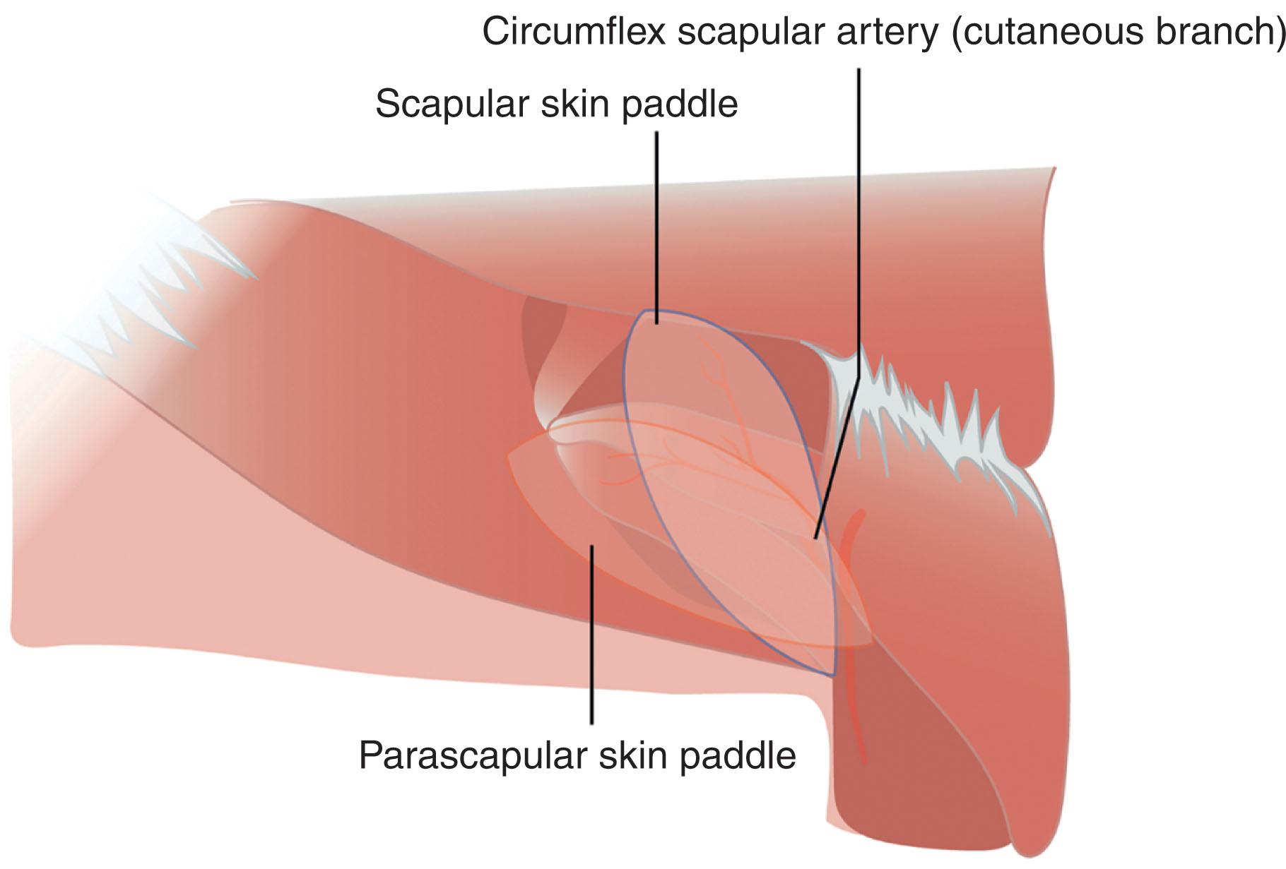 Figure 12.14, Scapular and parascapular flaps. The scapular and parascapular flaps are based off the circumflex scapular artery. The scapular flap is oriented parallel to the scapular spine, while the parascapular flap is oriented perpendicular to it.