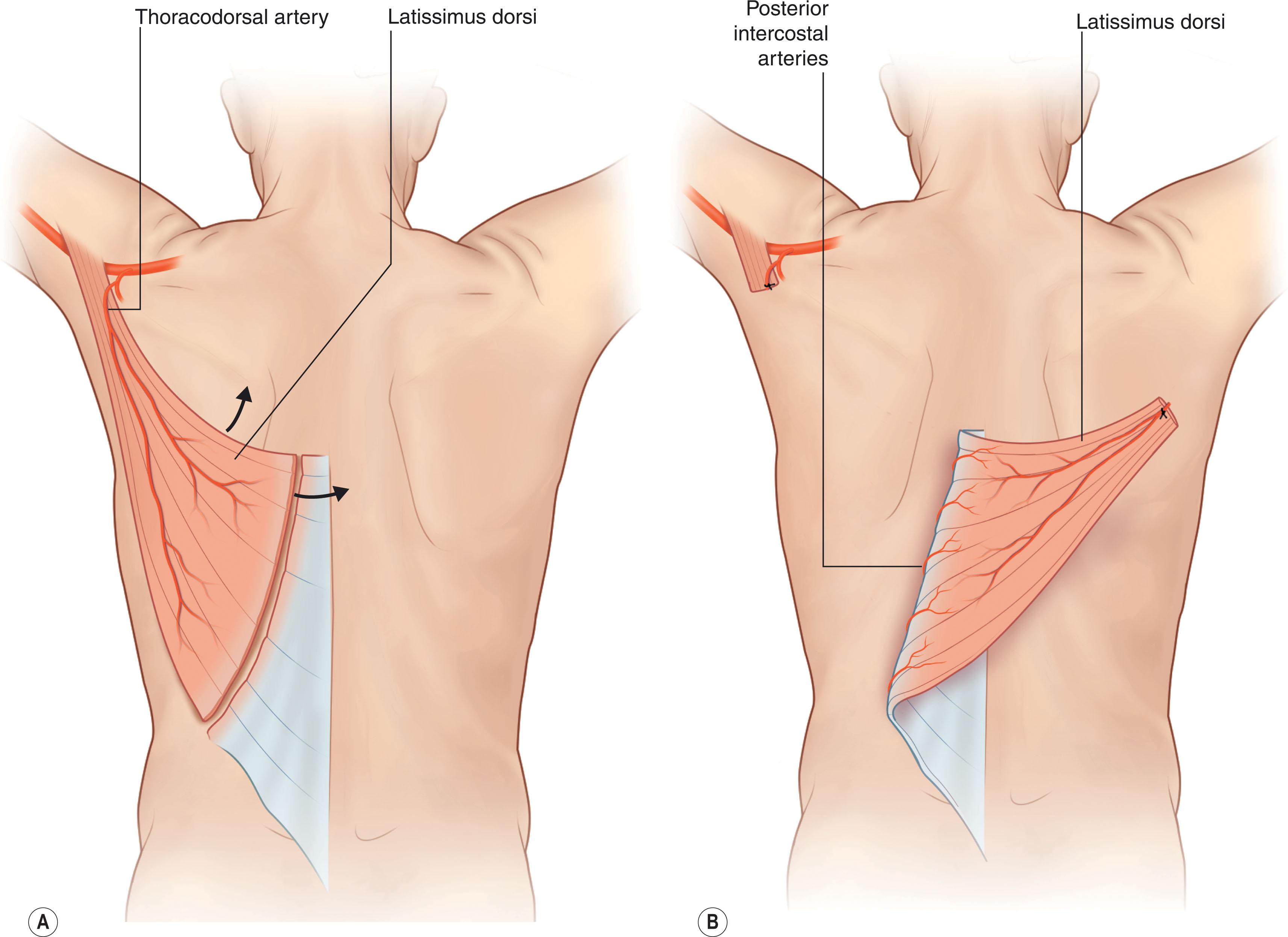 Figure 12.15, Latissimus dorsi flap variations. The latissimus dorsi flap is a versatile flap that can be based either on its primary or secondary (segmental) blood supply, allowing for great flexibility in flap design. (A) Is a traditional latissimus dorsi flap based off the thoracodorsal artery, this can be used as a locoregional flap or a free flap. (B) Demonstrates a turnover latissimus dorsi muscle flap based off the posterior intercostal arteries.