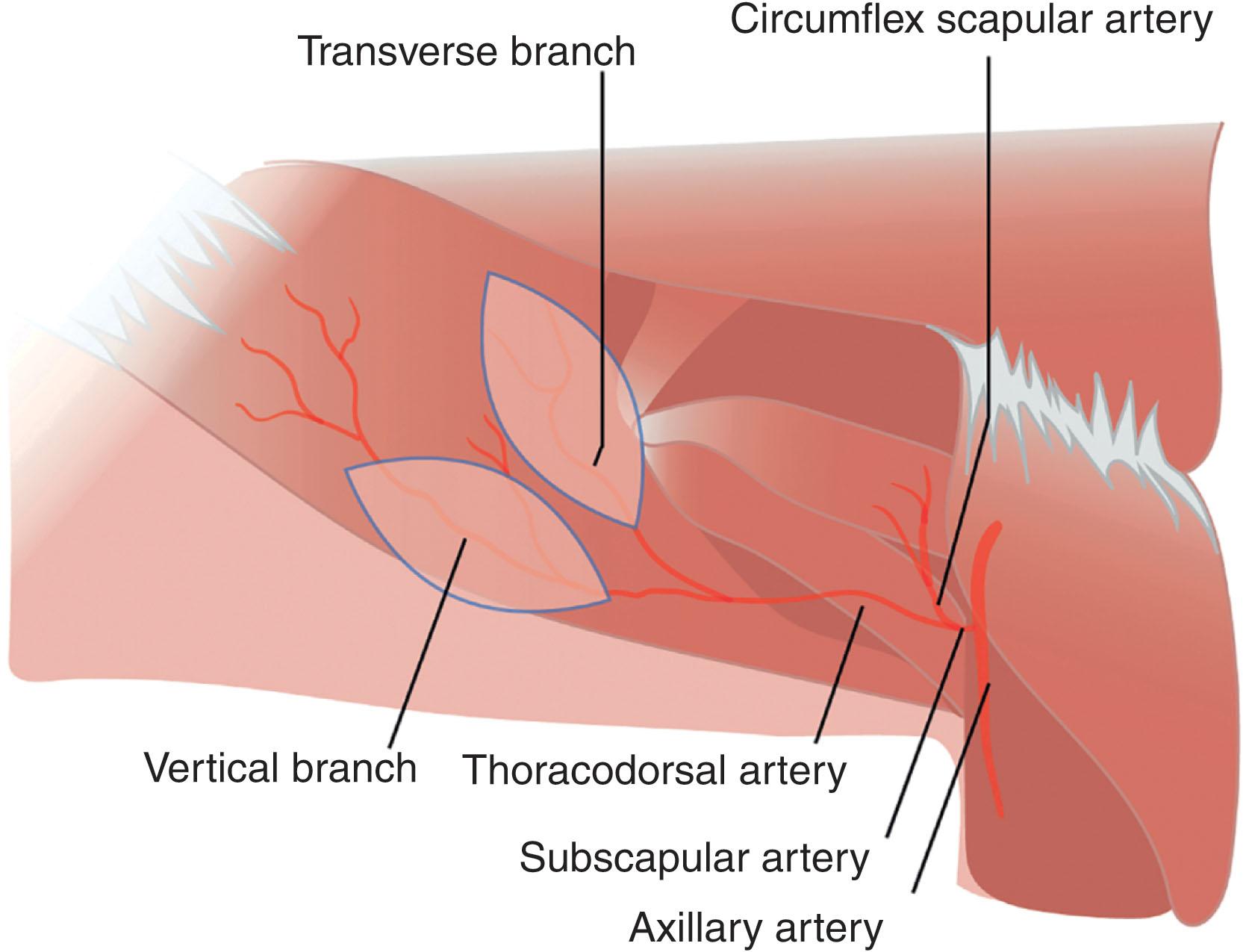 Figure 12.16, Thoracodorsal artery perforator (TDAP) flap variations. The TDAP flap is based off perforators from either the transverse or vertical branch of the thoracodorsal artery.