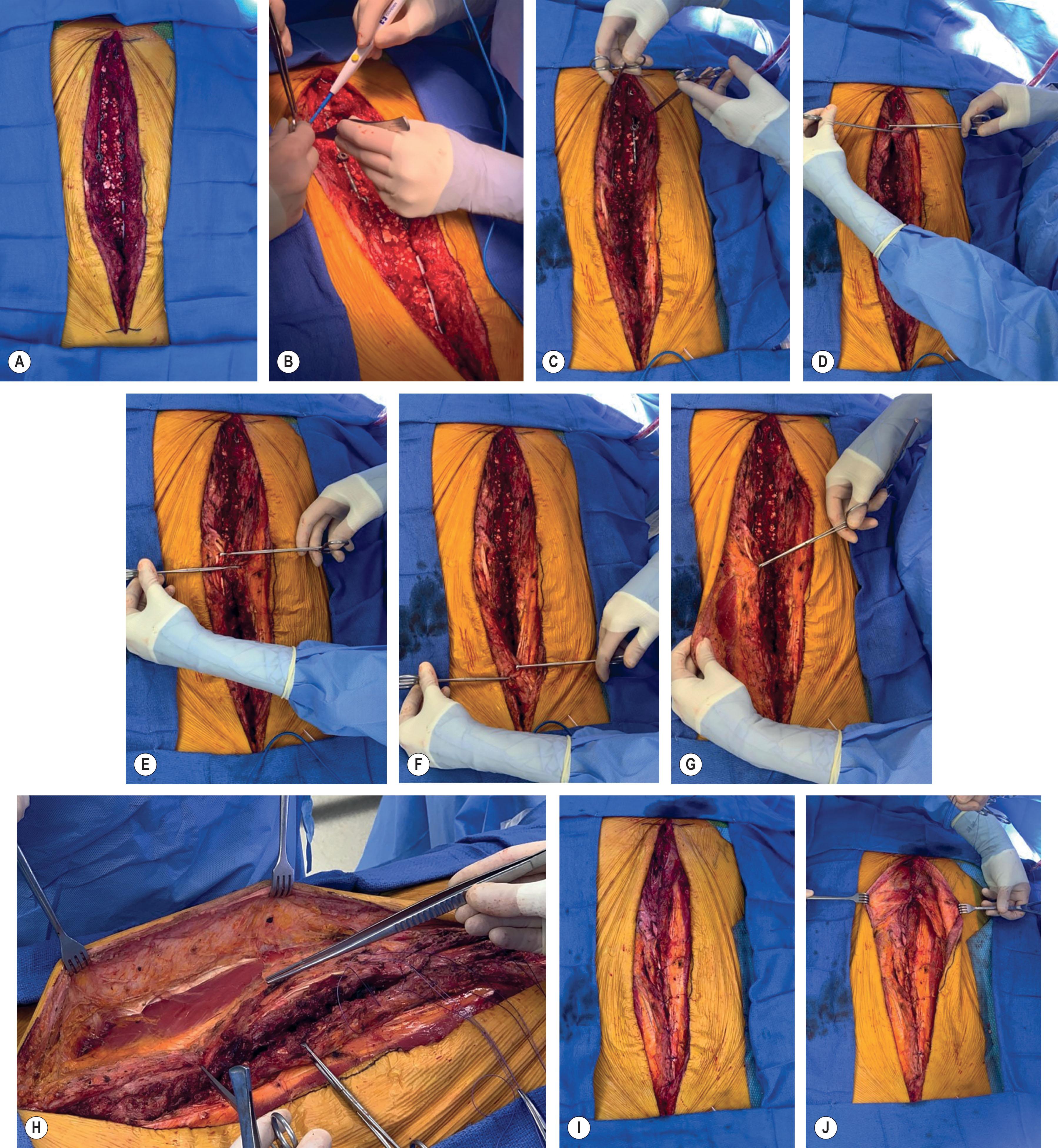 Figure 12.18, Paraspinous and latissimus dorsi muscle flaps. Case example of a 65-year-old female patient with a history of lumbar scoliosis with a midline posterior trunk defect and spinal hardware after lumbar arthrodesis. The patient underwent reconstruction with paraspinous and latissimus dorsi muscle flaps. (A–C) Dissection and mobilization of the paraspinous muscle complex was performed with cautery dissection in the superficial plane, from the midline laterally for approximately 7 cm starting on the left. This dissection was performed for the length of the defect and then repeated on the right side. (D–F) Good paraspinous approximation was obtained along the full length of the defect. (G,H) The latissimus dorsi muscles, superficial to the paraspinous muscles along the length of the defect, were dissected and mobilized to provide an additional layer of muscle flap coverage. (I,J) The paraspinous muscle then latissimus dorsi muscle flaps were co-apted in the midline by placement of interrupted 0 Vicryl figure-of-eight sutures. (K) Two superficial 15 F Blake drains were placed and brought out the patient’s left side (deep drain placed by neurosurgery on right side). The wound was closed in a multilayered fashion and reinforced with horizontal mattress sutures. (L) An incisional wound vacuum-assisted closure (VAC) device was then applied.