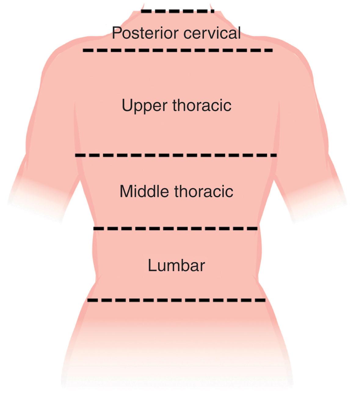 Figure 12.4, Regions of the posterior trunk. The four reconstructive regions of the posterior trunk are shown below. The regions each contain a preferred flap option, which can serve as a starting point to help to guide reconstructive efforts.