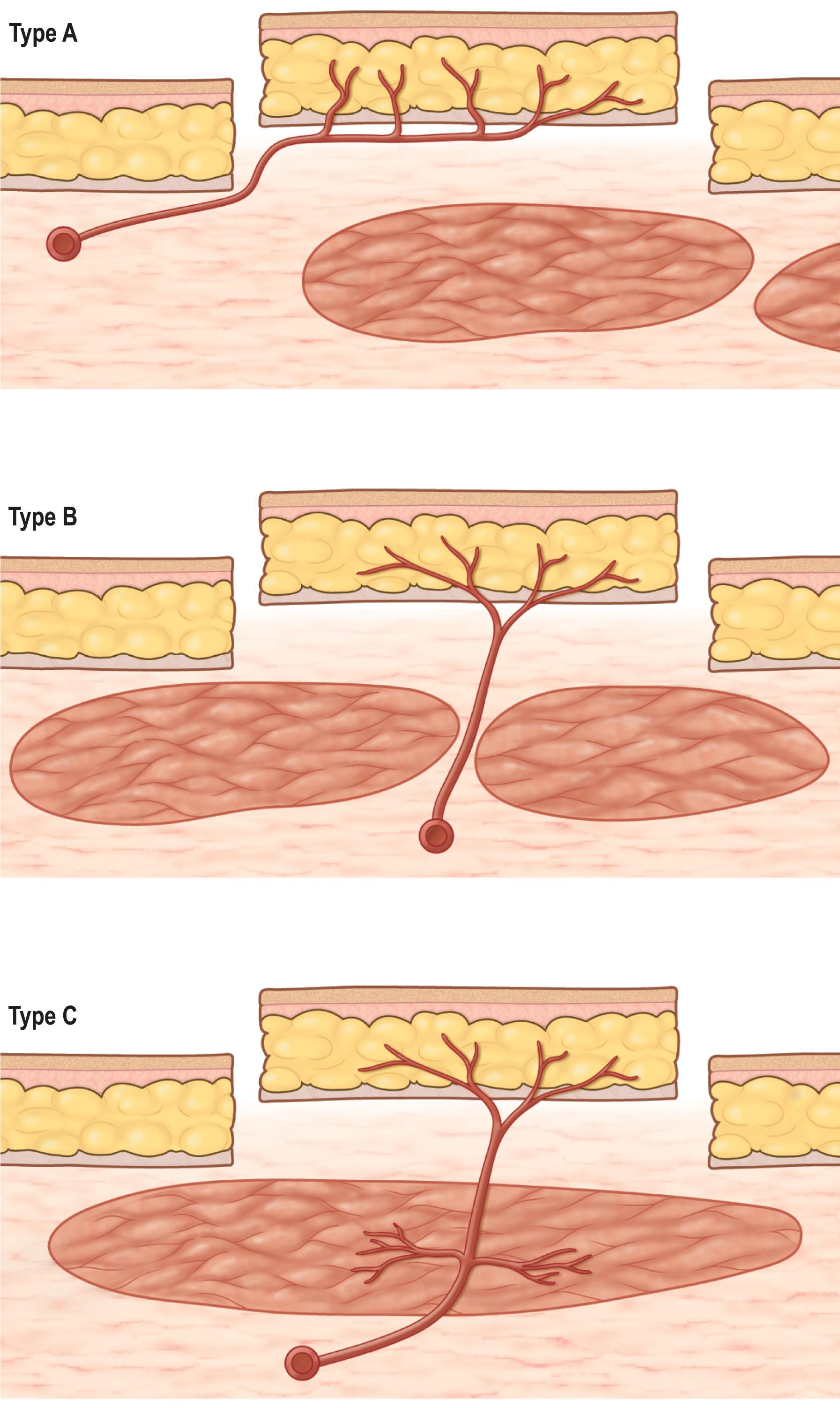 Figure 12.5, Classification of perforator flaps. Perforators can be classified into direct cutaneous (type A), septocutaneous (type B), and musculocutaneous (type C) branches.