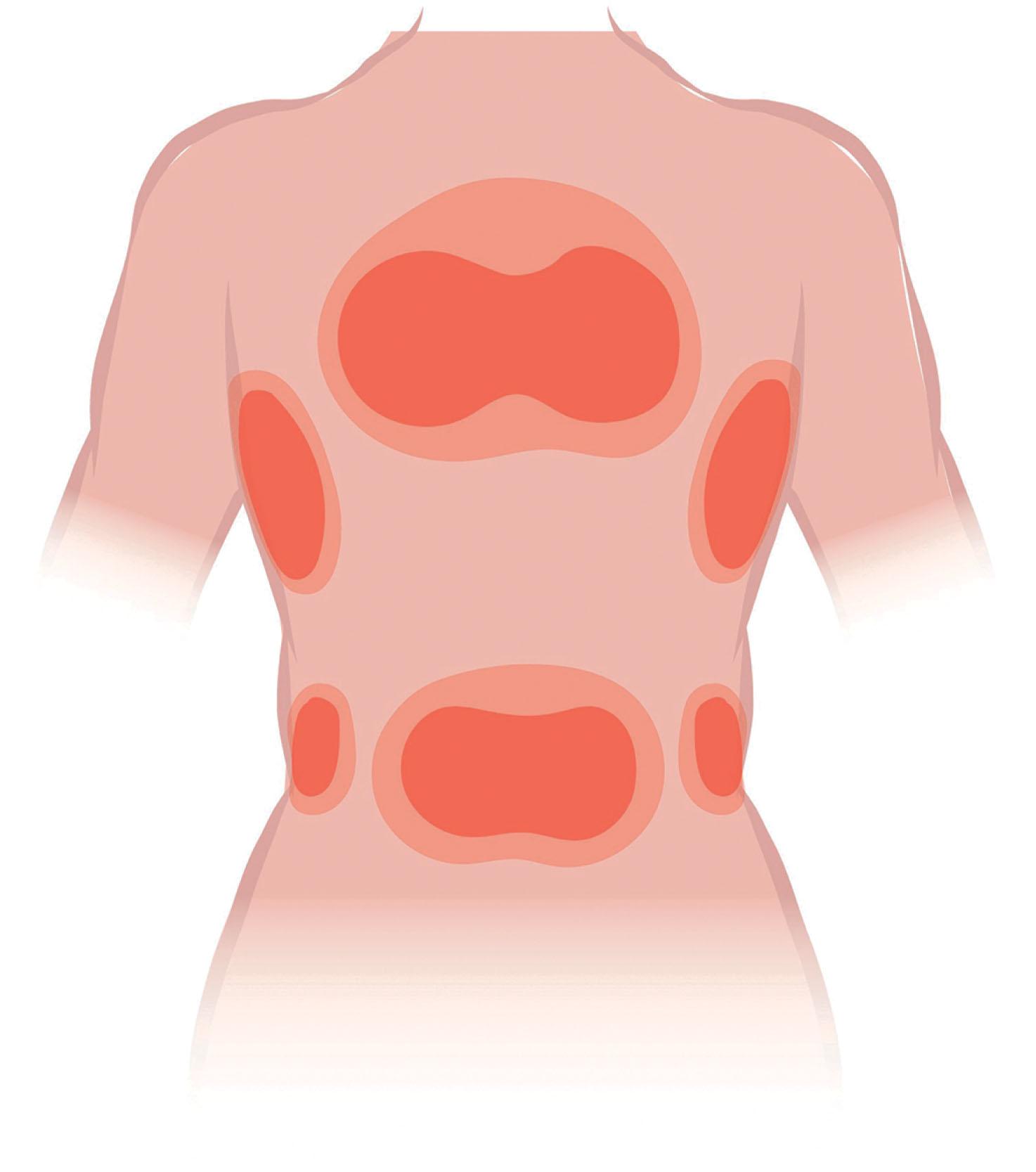 Figure 12.6, Distribution of thoracic and lumbar perforators. The posterior trunk contains perforator “hot spots”, regions in which the likelihood of finding a perforator is high. The cluster of perforators decreases in density toward the periphery.