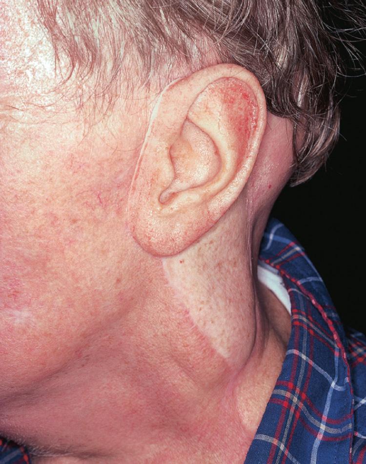 Figure 17.4, The overall cosmetic result is greatly enhanced by use of a prosthesis for the external ear in the patient shown in Fig. 17.3 .