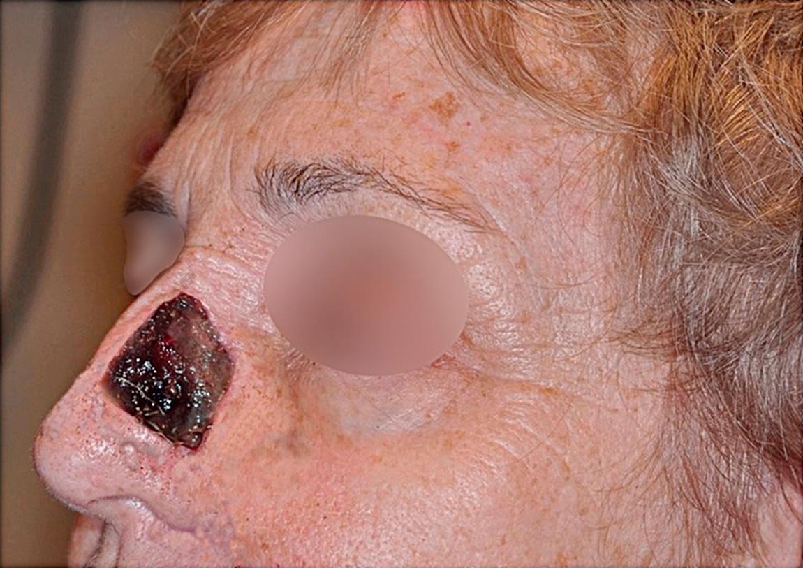 Figure 17.6, A full-thickness defect of the left nasal sidewall after removal of a melanoma before secondary application of full-thickness skin graft.