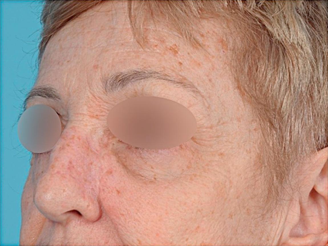 Figure 17.7, The postoperative appearance of the patient seen in Fig. 17.6 1 year following surgery showing complete healing and an excellent aesthetic outcome with a full-thickness skin graft.