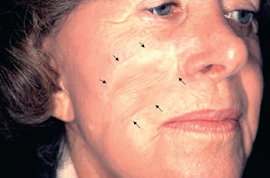 Figure 17.8, The postoperative appearance of a patient after full-thickness skin graft repair of a skin defect of the cheek ( arrows ).