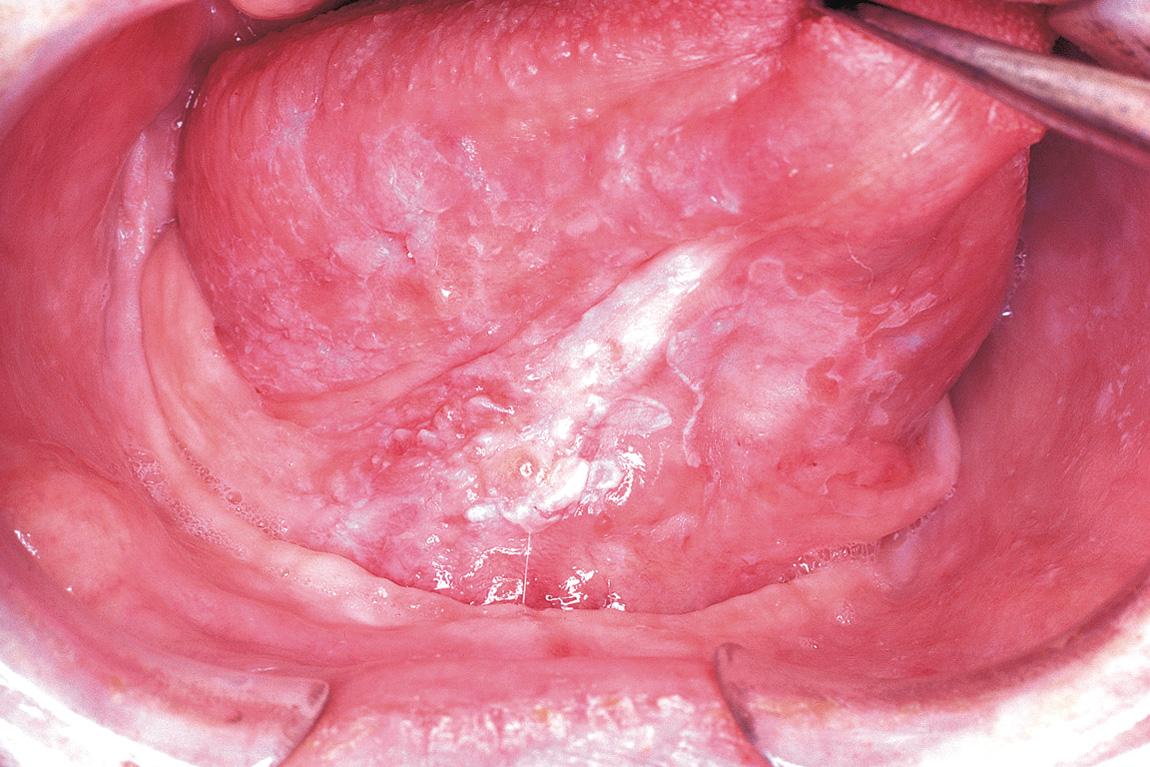 Figure 17.9, A superficially invasive carcinoma of the anterior floor of the mouth.