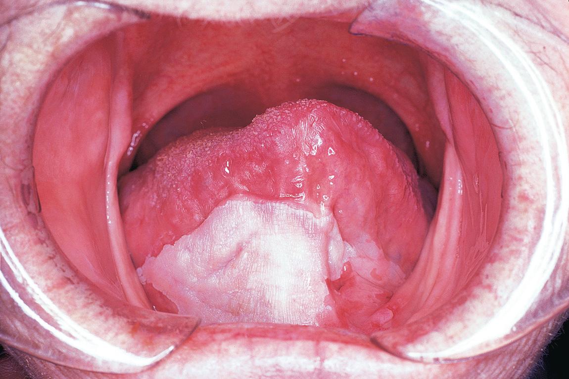 Figure 17.10, The postoperative appearance of the skin graft 3 months following surgery.