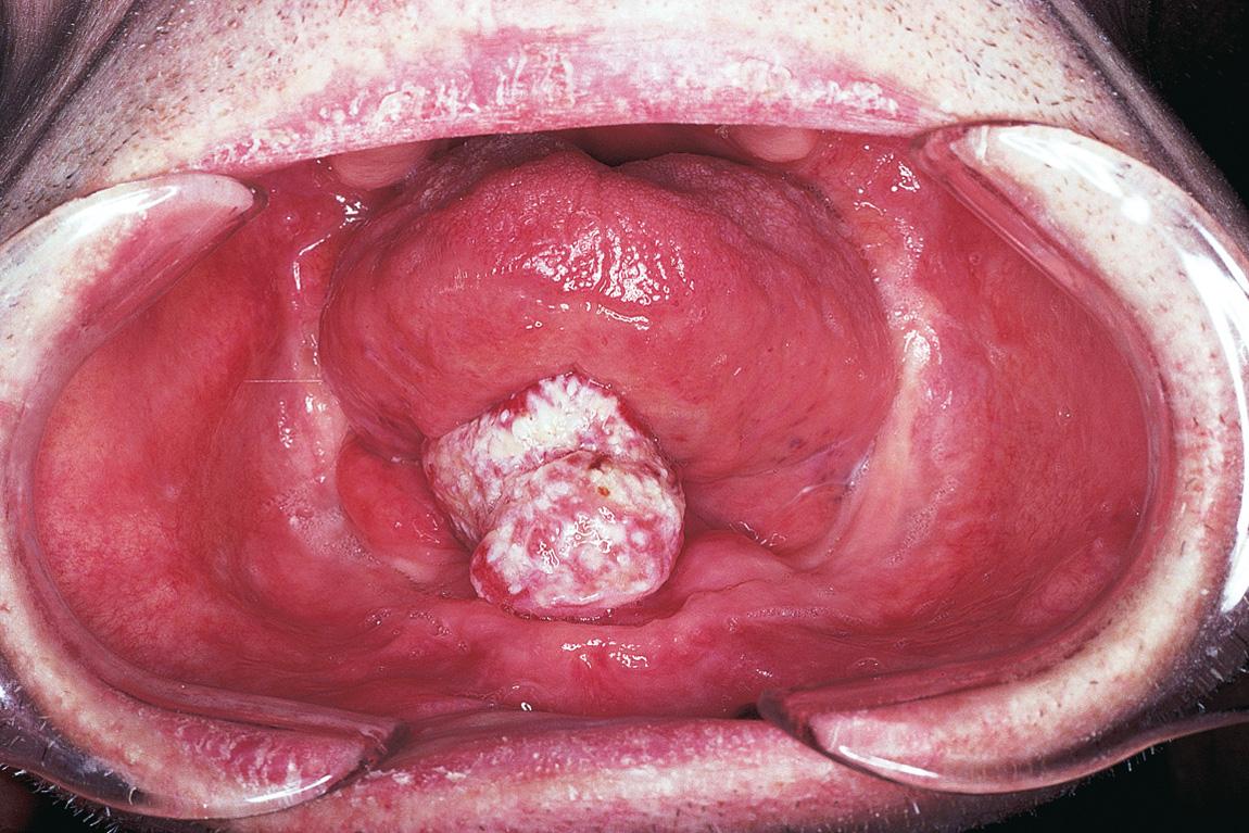 Figure 17.11, A squamous cell carcinoma of the lower gum and adjacent floor of the mouth in an edentulous patient.