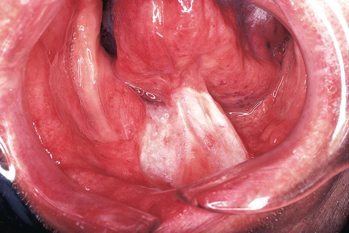 Figure 17.12, The postoperative result 3 months following surgery shows a healed split-thickness skin graft with excellent mobility of the tongue.