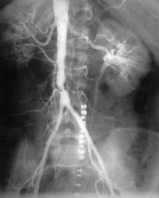 Fig. 21.2, Aortoiliac occlusive disease may consist of a short segment stenosis localized to the distal aorta, a lesion particularly common in young female smokers. Such a lesion may be amenable to endarterectomy.