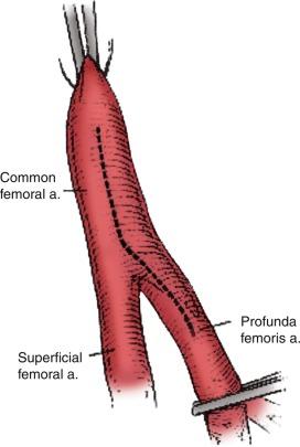 Fig. 21.3, In the setting of superficial femoral artery and orificial profunda femoral artery disease, extending the common femoral arteriotomy into the origin of the profunda and performing a profundaplasty prior to completing the distal anastomosis of the aortobifemoral bypass will improve outflow and maximize graft patency.