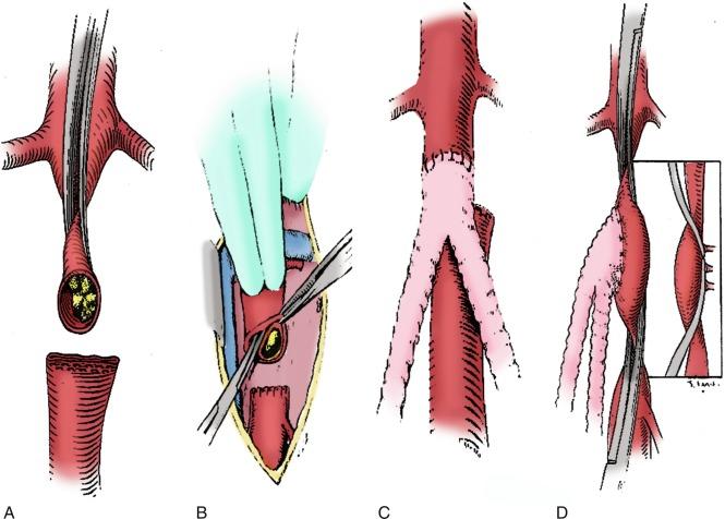 Fig. 21.4, The end-to-end proximal anastomosis for aortofemoral reconstruction is initiated with the infrarenal aorta cross clamp placed in anterior/posterior direction as close to the origin of the renal arteries as possible. The aorta is transected 1 to 2 cm below the proximal clamp. A short segment of distal aortic cuff is excised and the aorta is stapled or oversewn just proximal to the origin of the inferior mesenteric artery (A). If necessary, a thromboendarterectomy of the aortic cuff is carried out (B). The end-to-end configuration allows the graft to lie flat against the vertebral column and results in less turbulent flow (C). An end-to-side configuration is required to preserve antegrade pelvic perfusion in situations where retrograde flow would be compromised due to heavily diseased or occluded external iliac arteries (D).