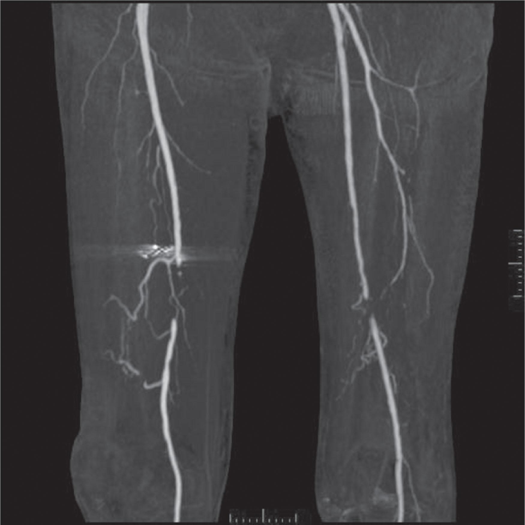 Figure 5.5, Preoperative computed tomographic angiogram revealing collateral flows on bilateral femoral arteries for a patient with diabetes and poor pedal pulses. The use of computed tomography angiography may obtain vascular information of the recipient region without the risk of complications. The preoperative is selectively recommended in patients who have loss of one or more peripheral pulses, a neurological deficit secondary to the injury, or a compound fracture of the extremity that has undergone reduction and either external or internal fixation.
