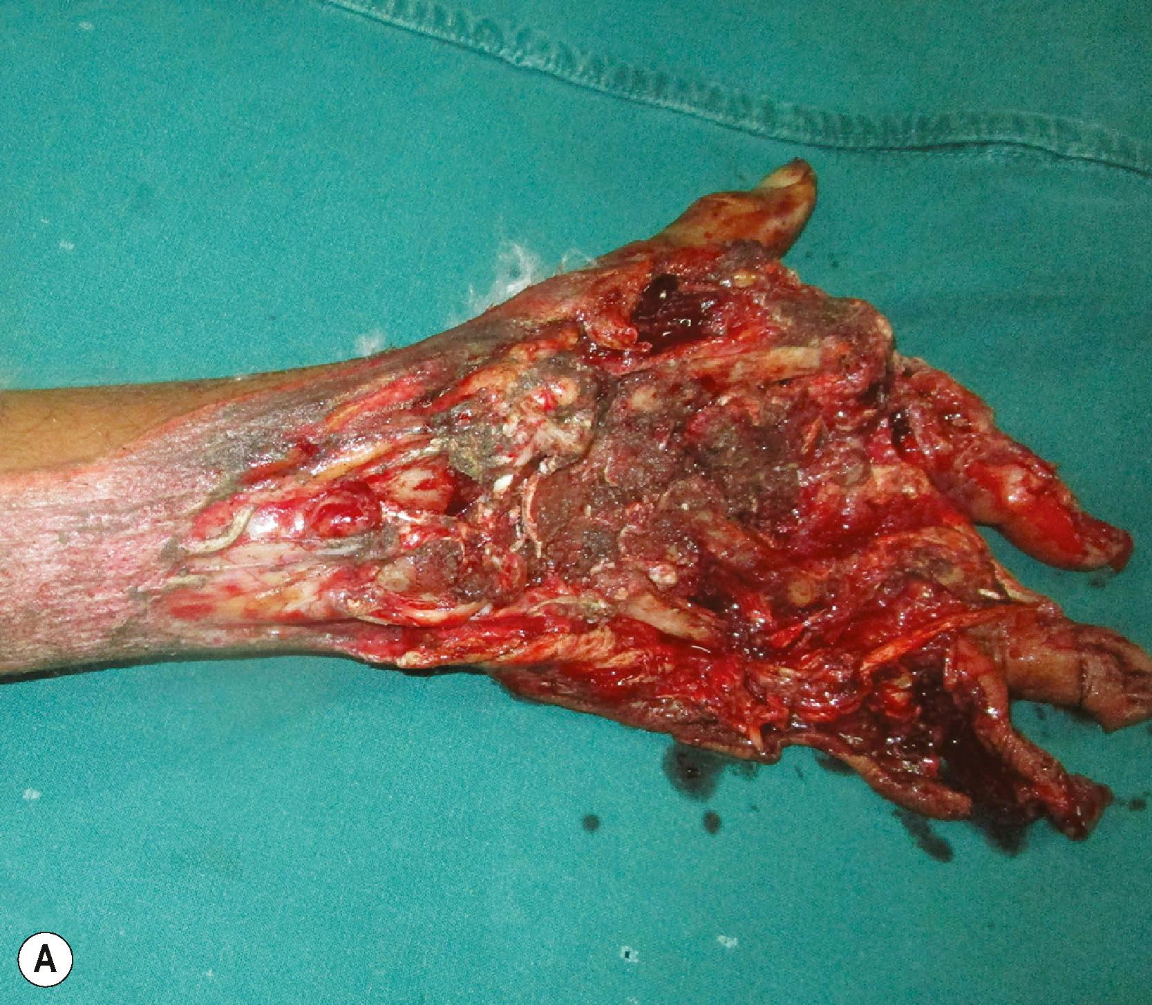 Figure 12.1, (A) Injury from a road traffic accident resulting in amputation of middle, ring and little fingers with composite tissue loss over the dorsum of the hand, wrist and distal forearm with massive contamination. (B) Post−debridement picture with stabilization of carpometacarpal joint and arthrodesis of the metacarpophalangeal and interphalangeal joints of the index. (C,D) Post groin flap cover, with a functional hand − a stable index, a mobile thumb with a good web space for pinch and grasp.