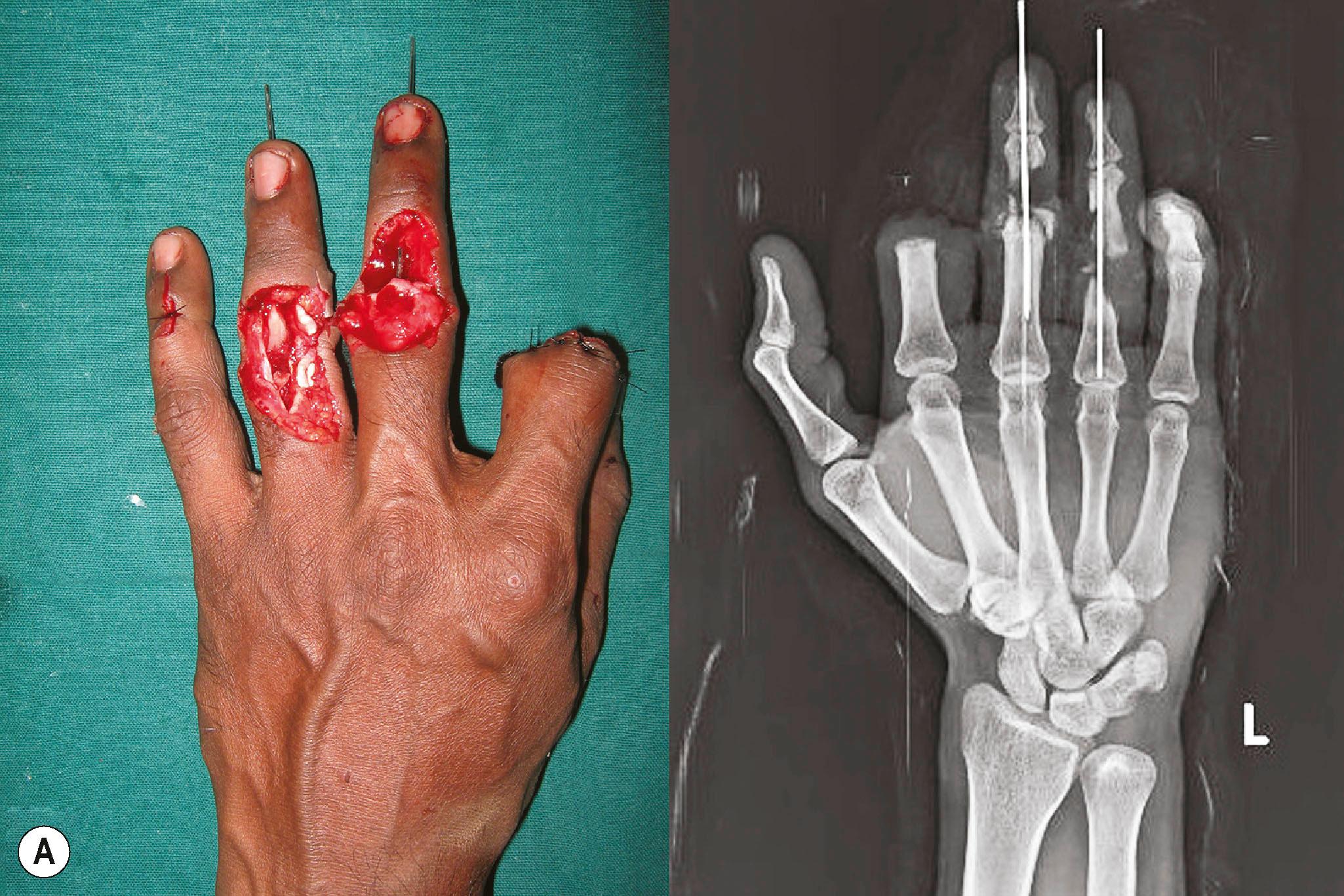 Figure 12.12, (A) Machine crush injury with amputation of the index and bone and soft−tissue loss in the middle and ring fingers. The fingers have been temporarily stabilized with a K−wire. (B) Iliac crest bone graft has been used to bridge the bone gaps, fixed with K−wire, and random pattern abdominal flaps marked in the groin region. (C) Flaps raised before inset. (D) Immediate radiographs of the bone grafts. (E) Well−settled flaps with stable fingers. (F) Long−term radiographs of the hand.