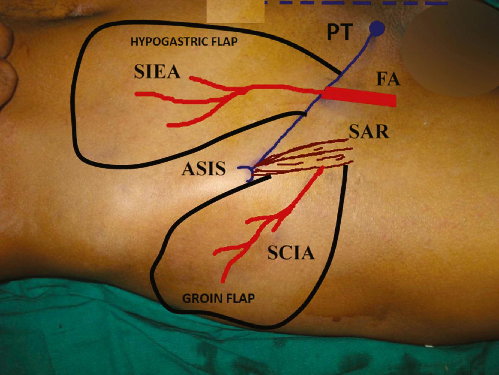 Figure 12.13, Salient landmarks for raising groin and hypogastric flaps. ASIS, anterior superior iliac spine; PT, pubic tubercle; FA, femoral artery; SAR, sartorius; SCIA, superficial circumflex iliac artery; SIEA, superficial inferior epigastric artery; and the territories of the groin and the hypogastric flaps are marked. The actual size can be wider.