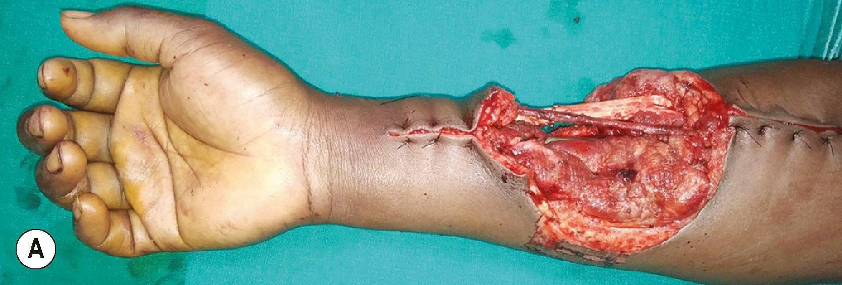 Figure 12.14, (A) Defect in the dorsal, radial and volar aspect of the forearm. (B) Such defects are covered more easily with paraumbilical flaps. Please also note the three lines drawn on the forearm extended on either side to the abdominal wall. That helps to guide the patient and the family for proper positioning of the hand.