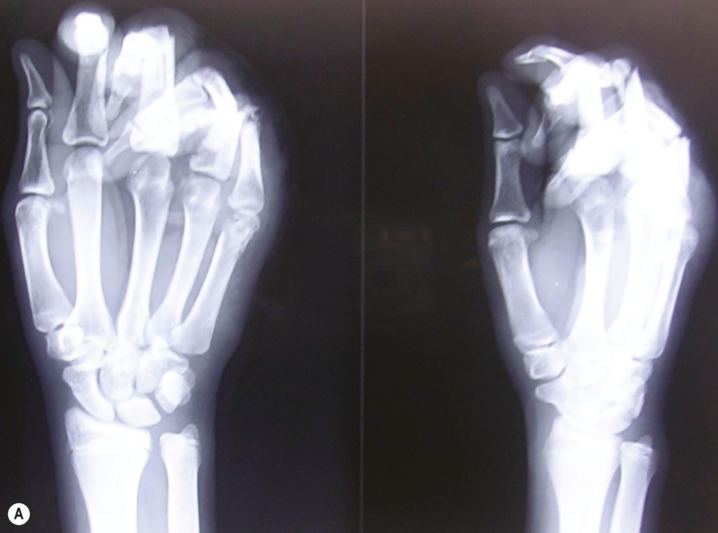 Figure 12.3, (A) Radiographs of a mutilated hand injury as referred from another center with a radiograph taken with the bandages. (B) Radiograph taken after on arrival brachial plexus block with clear visualization of the fractures.