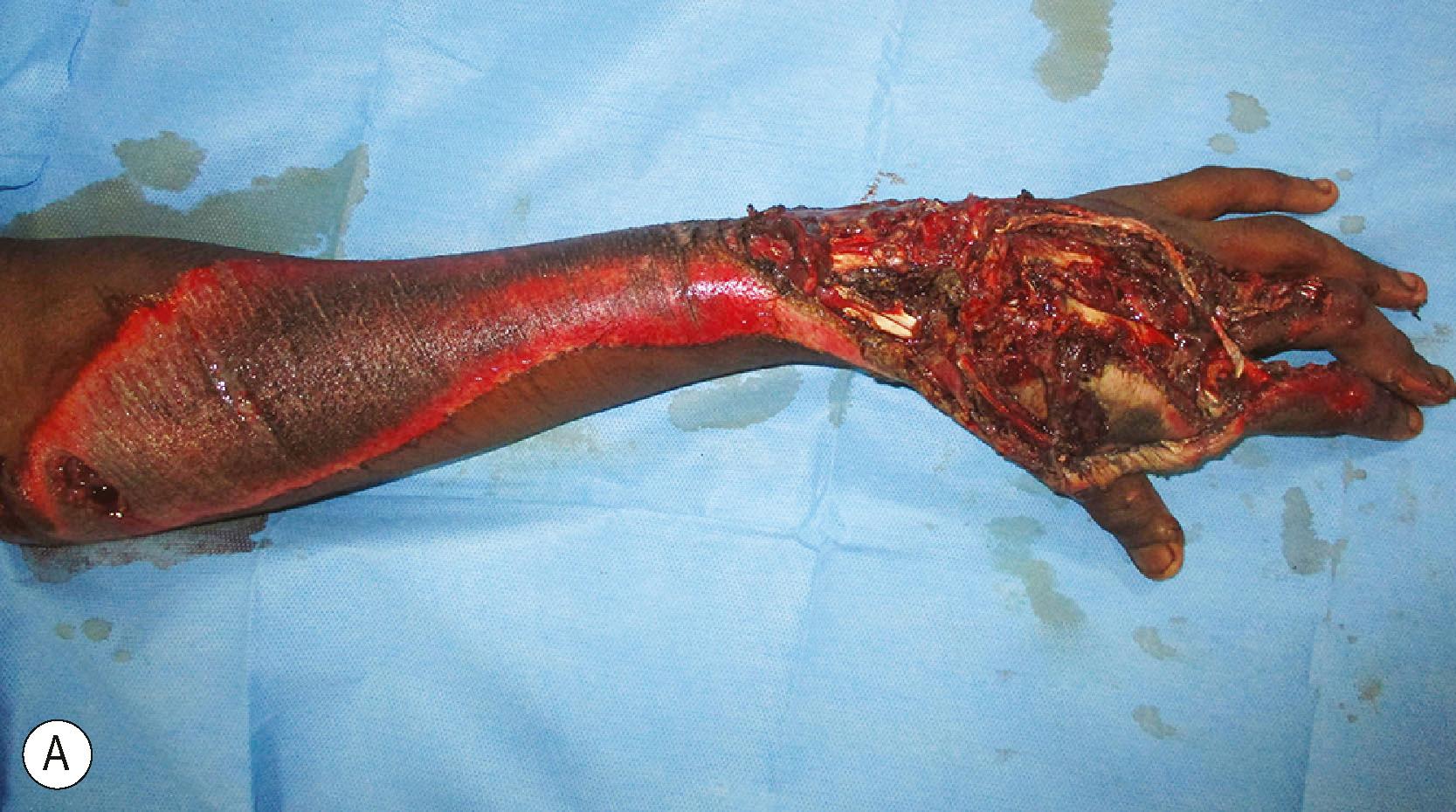 Figure 12.4, (A) Abrasive injury sustained in a road traffic accident with gross contamination. (B) The hand showing loss of skin and extensors and open joints. (C,D) The status post debridement (retaining only viable tissues). The contaminated abraded proximal area is shaved off to remove the contaminants. Critical raw areas were covered with flap and the rest of the raw area covered with skin graft, and extensor tendon reconstructed with fascia lata tendon grafts. (E,F) Post extensor tendon reconstruction with stable wrist, active finger extension, and good flexion of all fingers.