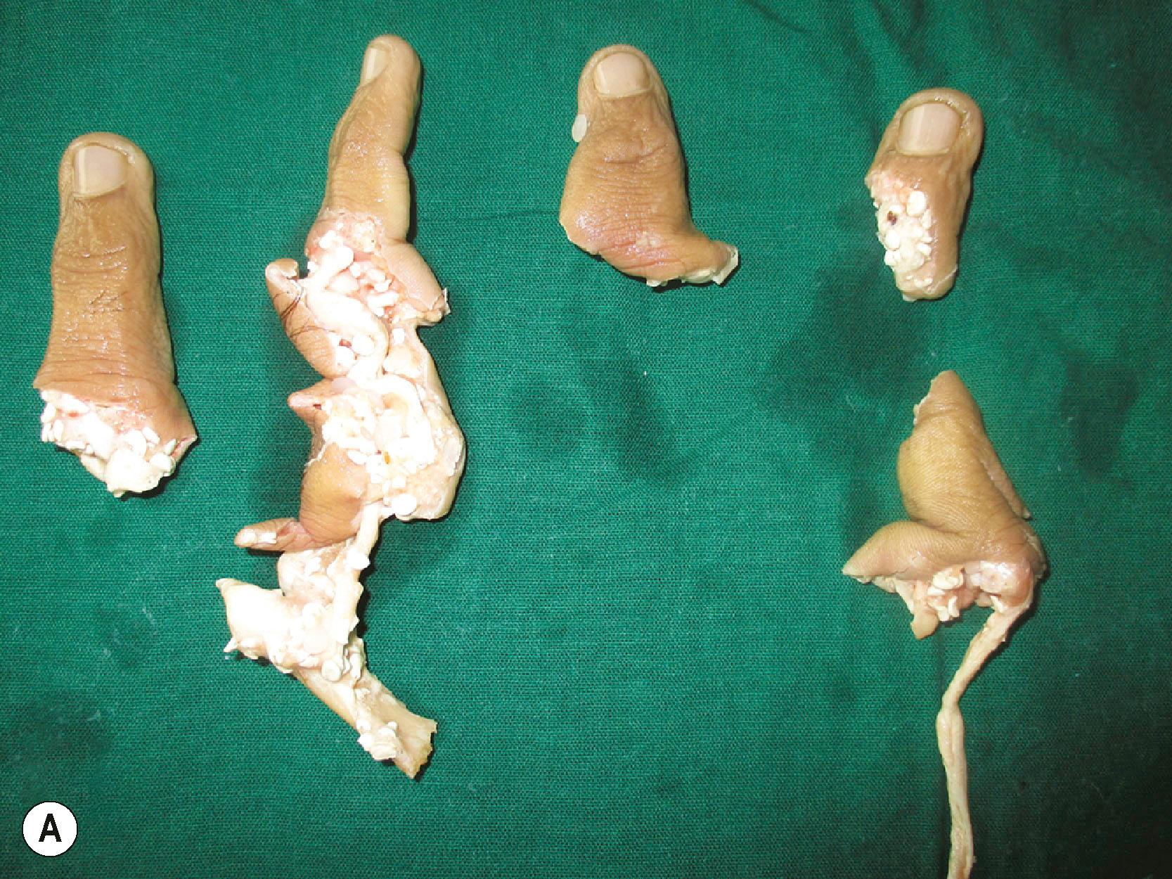 Figure 12.7, (A) Amputated fingers of index, middle, ring, and little fingers in a home injury. (B) The proximal part. (C,D) Heterotopic replantation of middle finger over the stump of the index finger providing good pinch and grasp