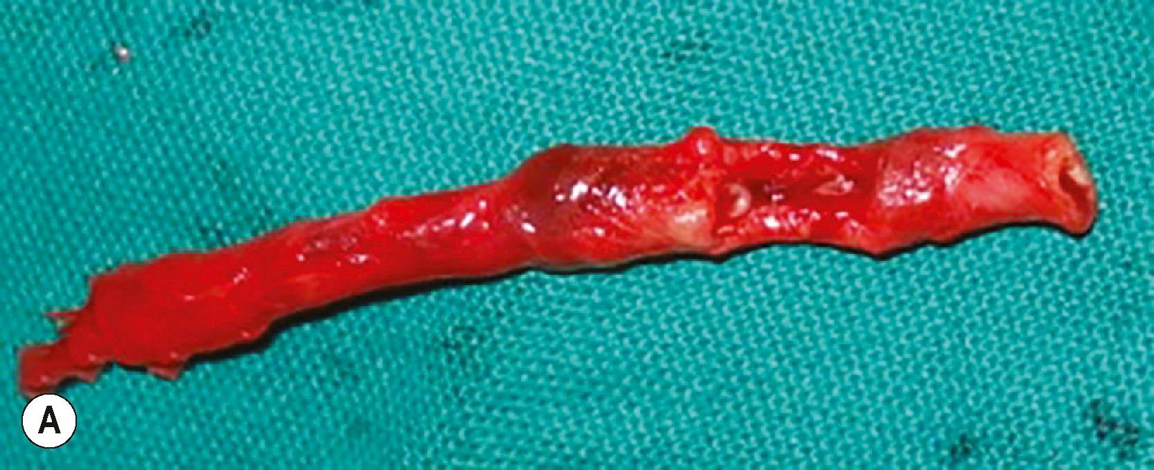 Figure 12.8, (A) The excised arterial segment of the brachial artery for a lesion in continuity. There was thrombosis at the site of injury and the segment was excised for reconstruction with vein graft. (B) The slit view of the artery showing intimal damage at the site of impact showing that it is better to excise the segment and reconstruct than performing an embolectomy.