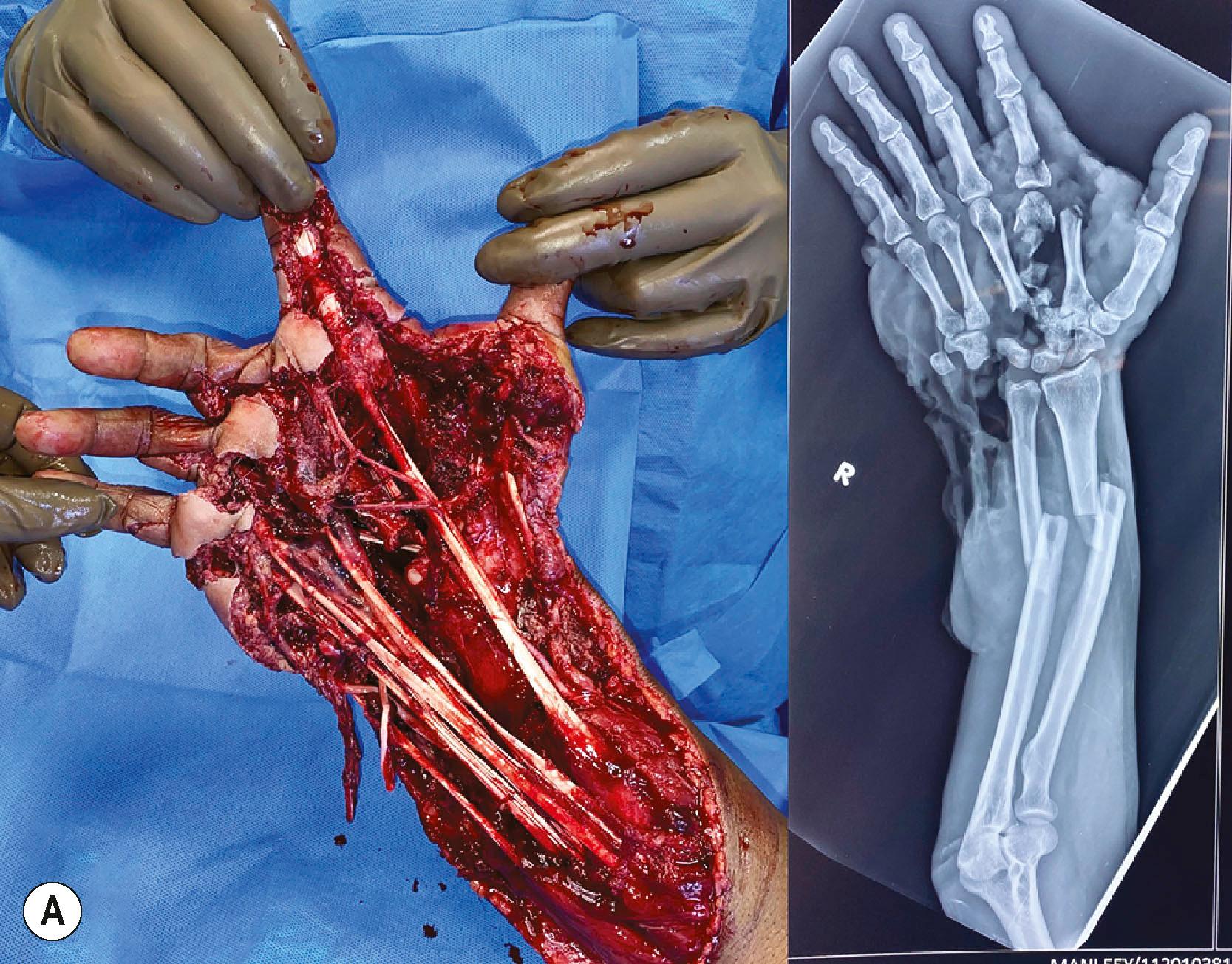 Figure 12.9, (A) Major crush injury to the hand and forearm, with radiograph taken with traction after an on−arrival block. (B) The distal part is avascular and a flow−through flap was planned. (C) The arterial anatomy and the anastomosis performed: white arrow points to the anastomosis of the flap artery to the proximal ulnar artery, the stars show the vessels to the flap, and the black arrow shows the artery to the rectus anastomosed to the distal ulnar artery to reconstruct the ulnar vessels. (D) The flap being inset. (E) The well−healed flap and a vascular hand.