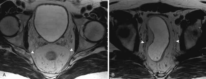 FIG 51-1, Normal mesorectal fascia. Axial ( A ) and coronal ( B ) T2-weighted images demonstrate well-defined thin hypointense layer (arrowheads) surrounding the hyperintense mesorectal fat.