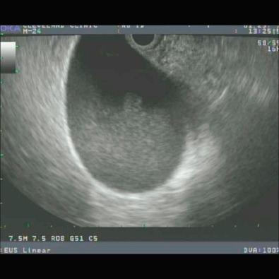 FIG 57.1, Gallbladder sludge seen on endoscopic ultrasound (EUS) in a 25-year-old woman with recurrent acute pancreatitis (RAP). She had slight alanine transaminase (ALT) elevations during the most recent bout. Transabdominal ultrasound (TAUS) was read as negative for stones. The attacks ceased after cholecystectomy was performed.
