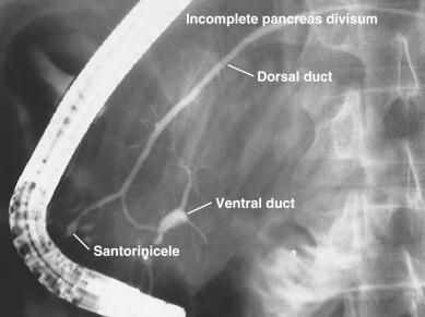 FIG 57.2, Endoscopic retrograde cholangiopancreatography (ERCP) performed on a patient with recurrent acute pancreatitis (RAP) shows incomplete pancreas divisum. The ventral duct and dorsal duct are connected by a small branch duct. At the most distal portion of the dorsal duct, a cystic outpunching (called a Santorinicele) is also seen. This patient responded to endoscopic minor papillotomy.