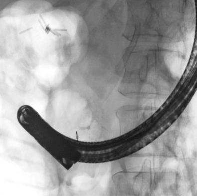 FIG 57.3, This 33-year-old female had presumed gallstone pancreatitis, but continued to have recurrent acute pancreatitis (RAP) following cholecystectomy. Endoscopic retrograde cholangiopancreatography (ERCP) with contrast injection of the ventral duct via the major papilla showed an arborized appearance, consistent with pancreas divisum.