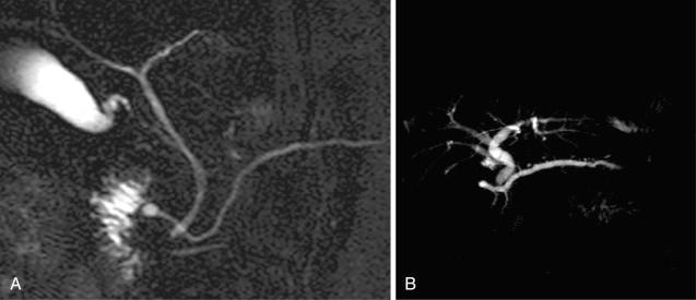 FIG 57.4, Magnetic resonance cholangiopancreatography (MRCP) examples of pancreas divisum with Santorinicele in two patients with recurrent acute pancreatitis (RAP). A, A 15-year-old boy with RAP. There is a normal caliber duct with a Santorinicele. Attacks ceased after endoscopic minor papillotomy. B, A 45-year-old man with RAP and chronic abdominal pain. MRCP shows a Santorinicele and a dilated dorsal duct with dilated side branches, indicating outflow obstruction and possible chronic pancreatitis. This patient had no further acute pancreatitis episodes after minor papillotomy, but continued to suffer with chronic daily pain.