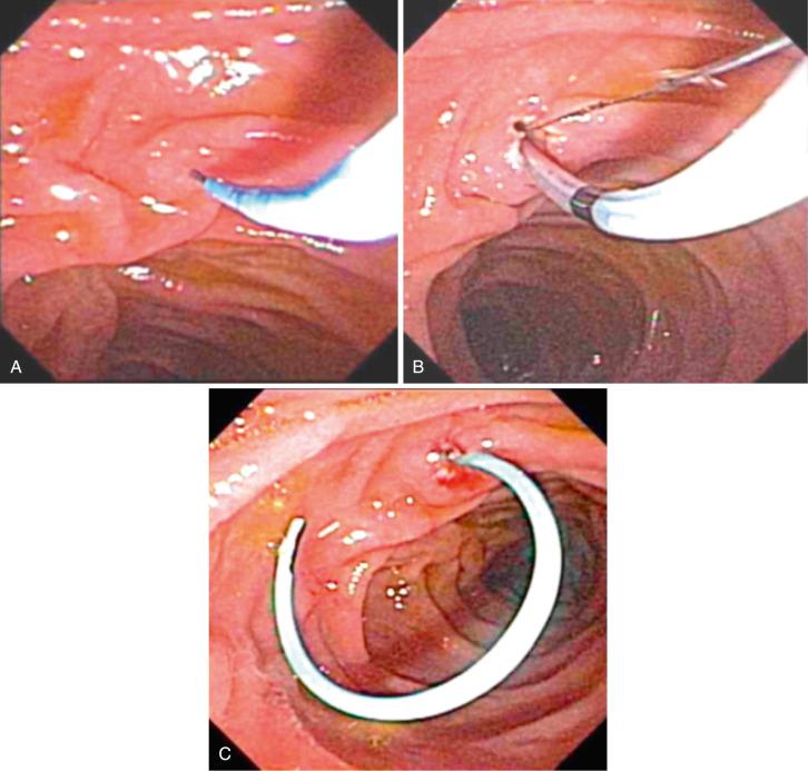 FIG 57.5, Endoscopic therapy for pancreas divisum. A, Wire cannulation is accomplished using a tapered-tip catheter with a 0.021-inch wire. B, After deep wire access is achieved, a minor papillotomy is performed using a traction sphincterotome and blended current. C, A 5-Fr single pigtail stent is placed to prevent post-endoscopic retrograde cholangiopancreatography (ERCP) pancreatitis.