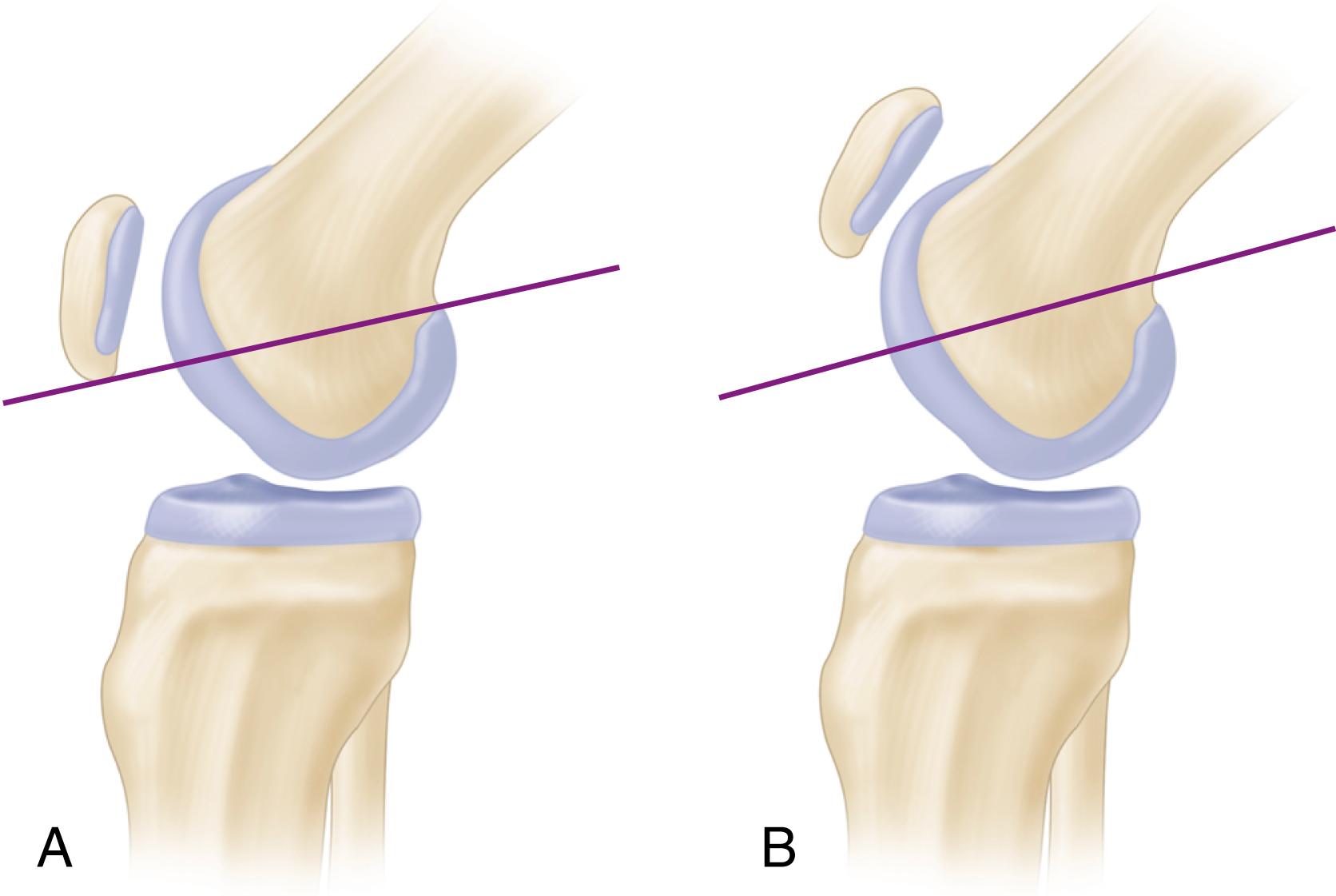 FIGURE 47.1, A, Normal knee. Lower pole of patella at Blumensaat line at 30 degrees of flexion of knee. B, Patella alta. Patella significantly proximal to Blumensaat line.