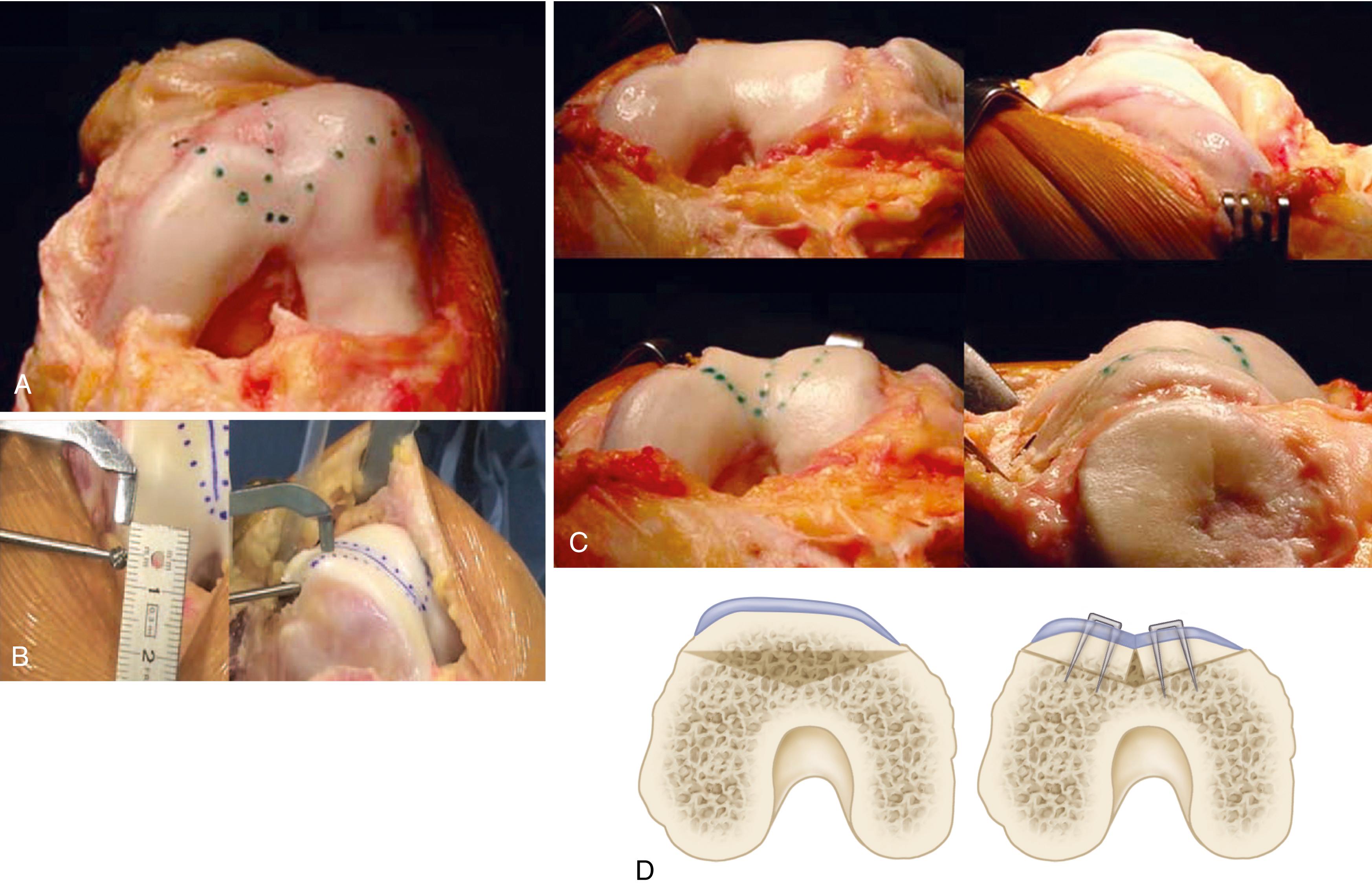 FIGURE 47.11, DeJour sulcus-deepening trochleoplasty. A, Drawing of the new trochlear limits. B, Removal of subchondral bone under the trochlea to correct the prominence and reshape the groove. C, Shape of the trochlea before (above) and after (below) sulcus-deepening trochleoplasty. D, Fixation of new trochlea with two staples after restoration of trochlear sulcus and more “anatomic” shape. (From DeJour D, Saggin P: The sulcus deepening trochleoplasty—the Lyon’s procedure, Int Orthop 34:311–316, 2010.) SEE TECHNIQUE 47.4.