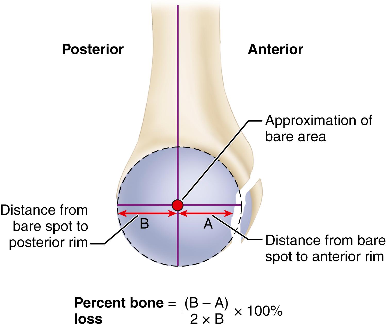 FIGURE 47.25, Estimation of bone loss based on glenoid rim distances. En face view of glenoid is viewed on a CT scan. With use of intersection of longitudinal axis and widest anteroposterior diameter of glenoid, the bare spot is approximated on the glenoid fossa. A best-fit circle centered at the bare-spot approximation is drawn about the inferior two thirds of the glenoid (red). Distances from the bare spot to anterior rim (A) and posterior rim (B) are measured. The percent bone loss is calculated according to the indicated equation.