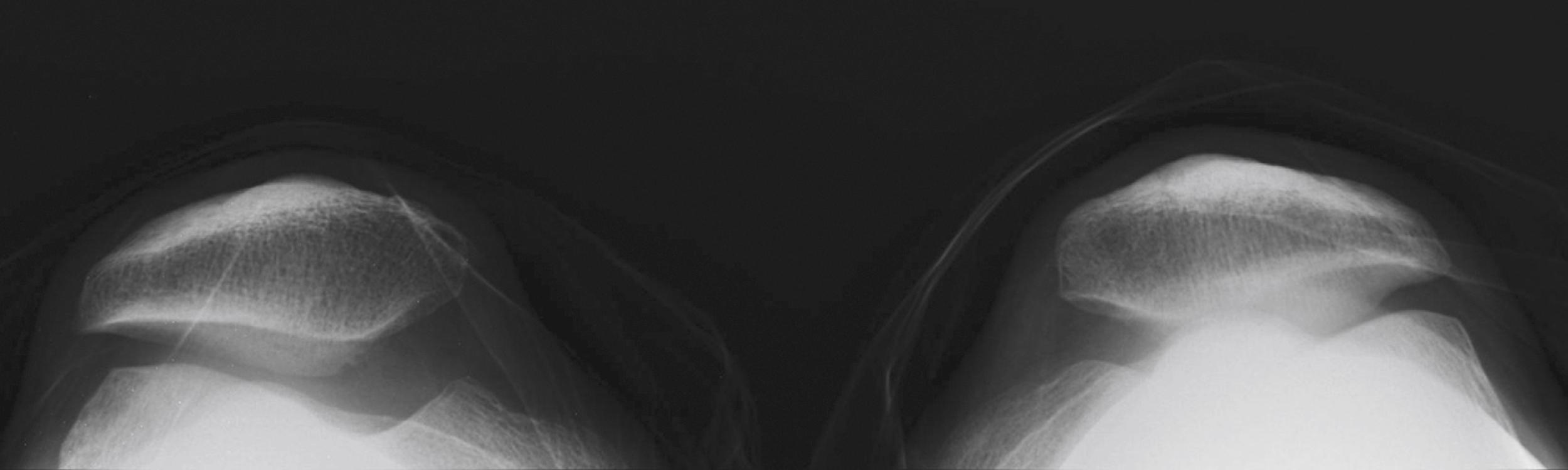 FIGURE 47.3, Lateral tilt of patella on axial view.