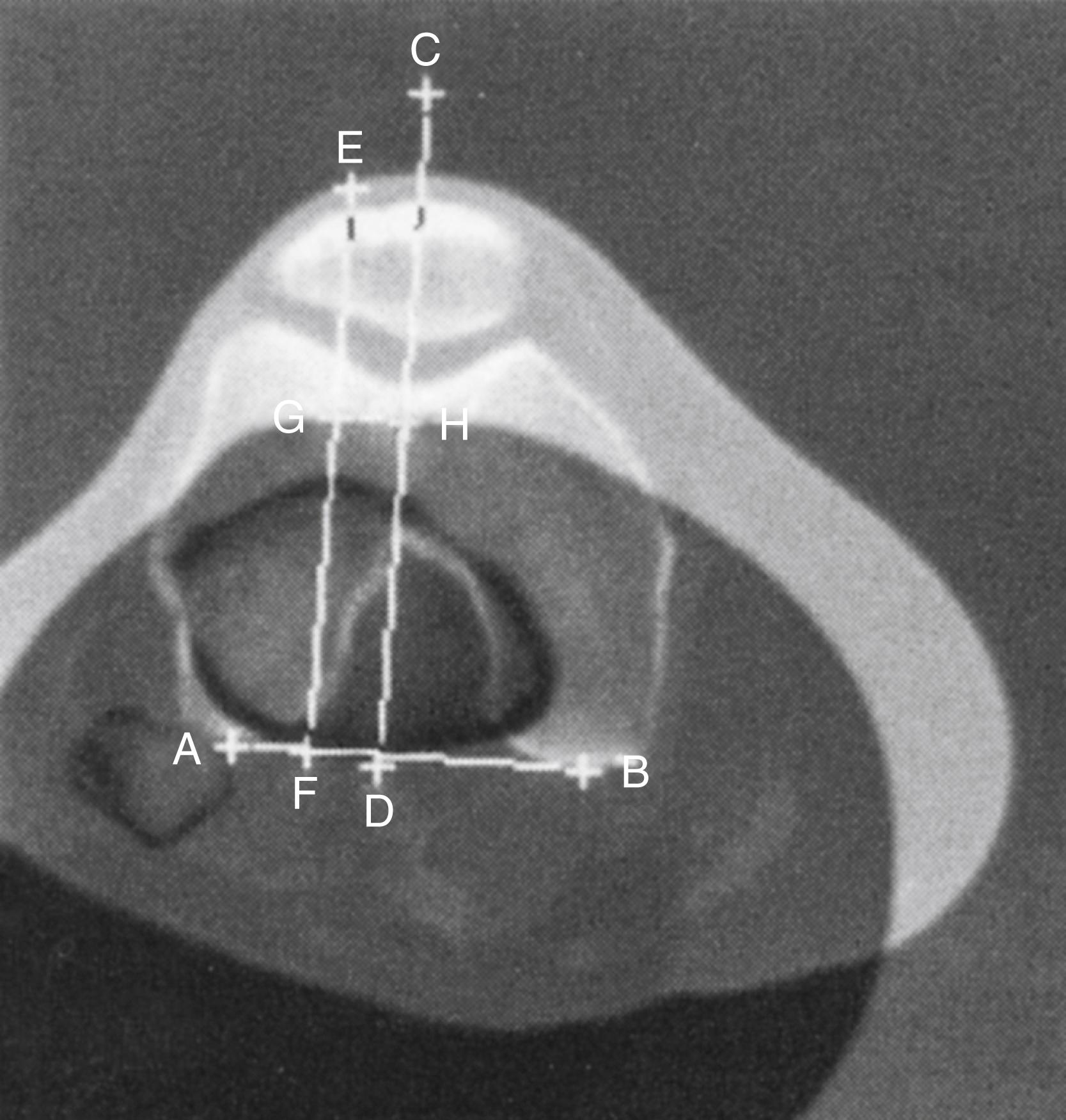FIGURE 47.6, Lines used to calculate tibial tubercle lateralization using CT. Line is drawn on superimposed image between posterior margins of femoral condyles (AB) . Two lines are drawn perpendicular to this, one bisecting femoral trochlear groove (CD) and one bisecting anterior tibial tuberosity through chosen point in center of patellar tendon insertion (EF). Distance between these two lines (GH) is measured in millimeters.