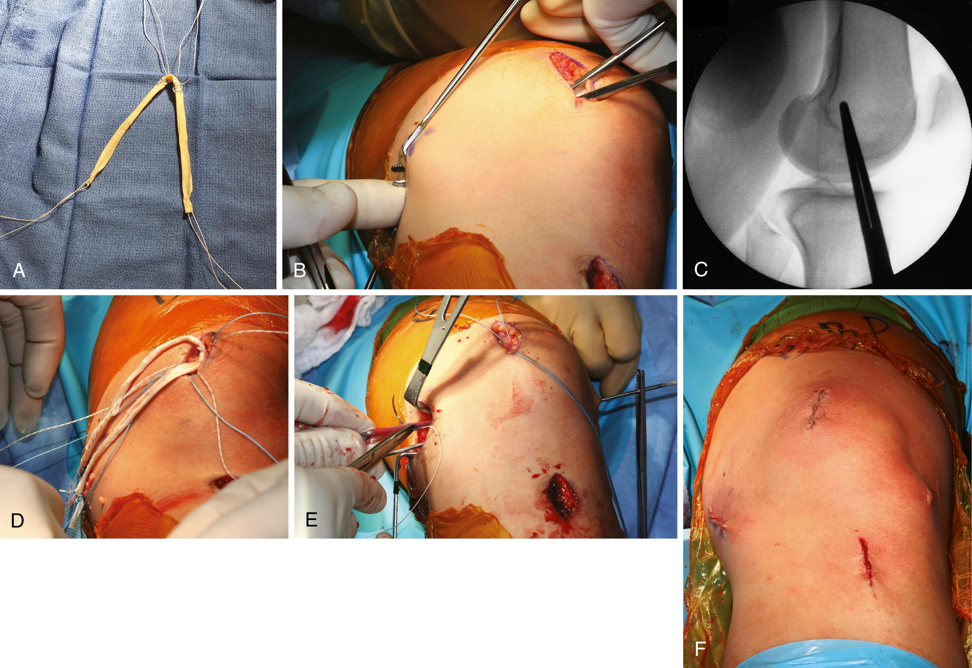 FIGURE 47.8, Phillips reconstruction of the medial patellofemoral ligament. A, Semitendinosus tendon graft. B, Creation of soft-tissue tunnel. C, Correct position confirmed radiographically. D, Whip stitch placed in each end of graft. E, Graft tails passed through soft-tissue tunnel. F, Closure. SEE TECHNIQUE 47.1.