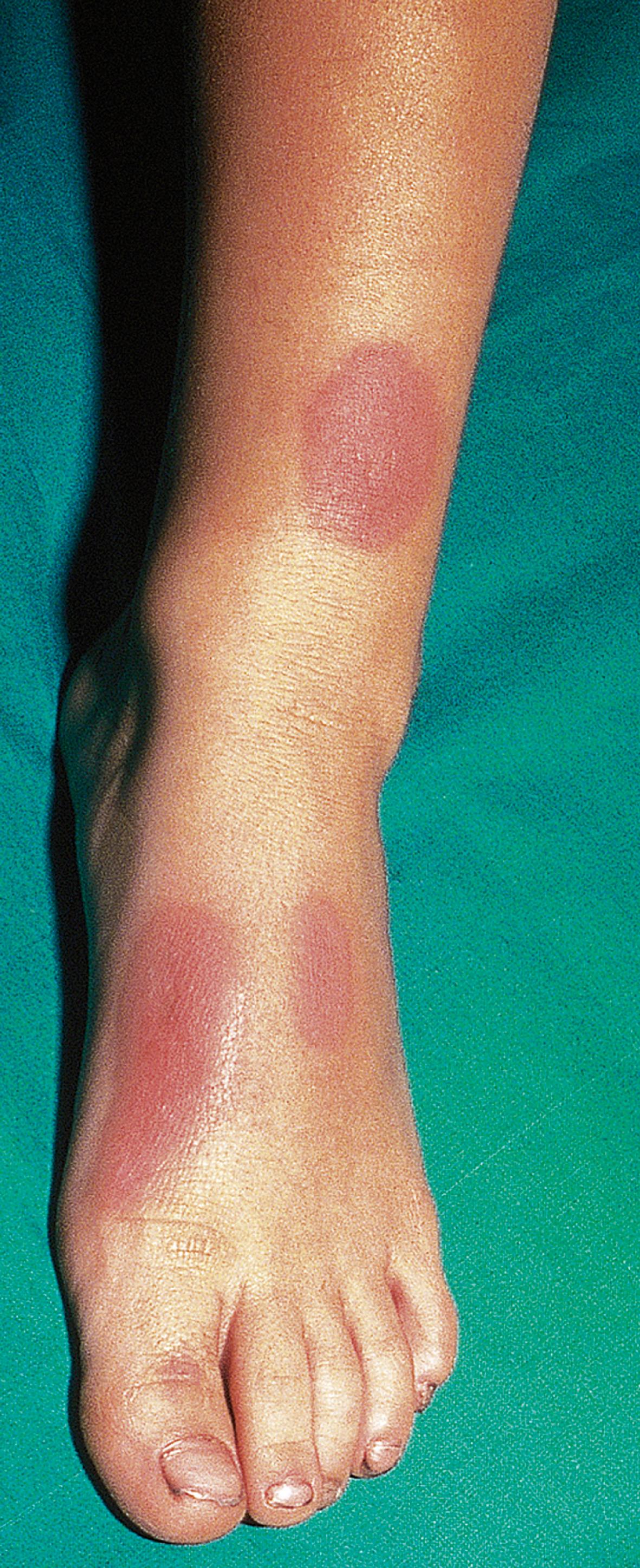 Fig. 54.1, Familial Mediterranean fever. Erythematous rash on the dorsal aspect of the foot and pretibial area of an affected child.
