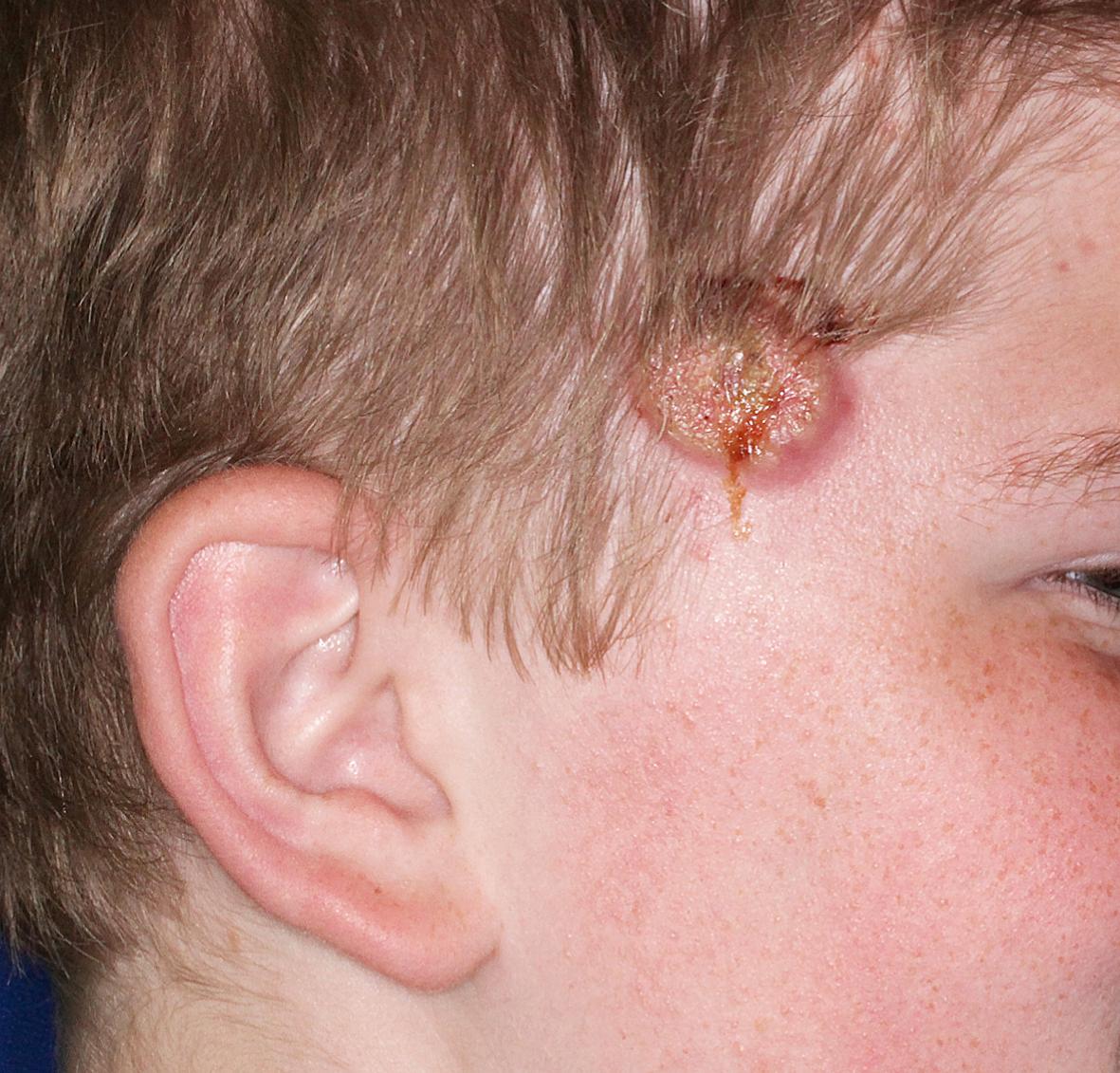 Fig. 54.2, Pyogenic sterile arthritis, pyoderma gangrenosum, and acne (PAPA) syndrome. This 11-year-old boy had small inflammatory papules of acne, which rapidly became purulent plaques (as shown) and then ulcerated to form pyoderma gangrenosum, leaving residual scars. He also had arthritis. His disease was brought under control with golimumab (tumor necrosis factor inhibitor) and isotretinoin.