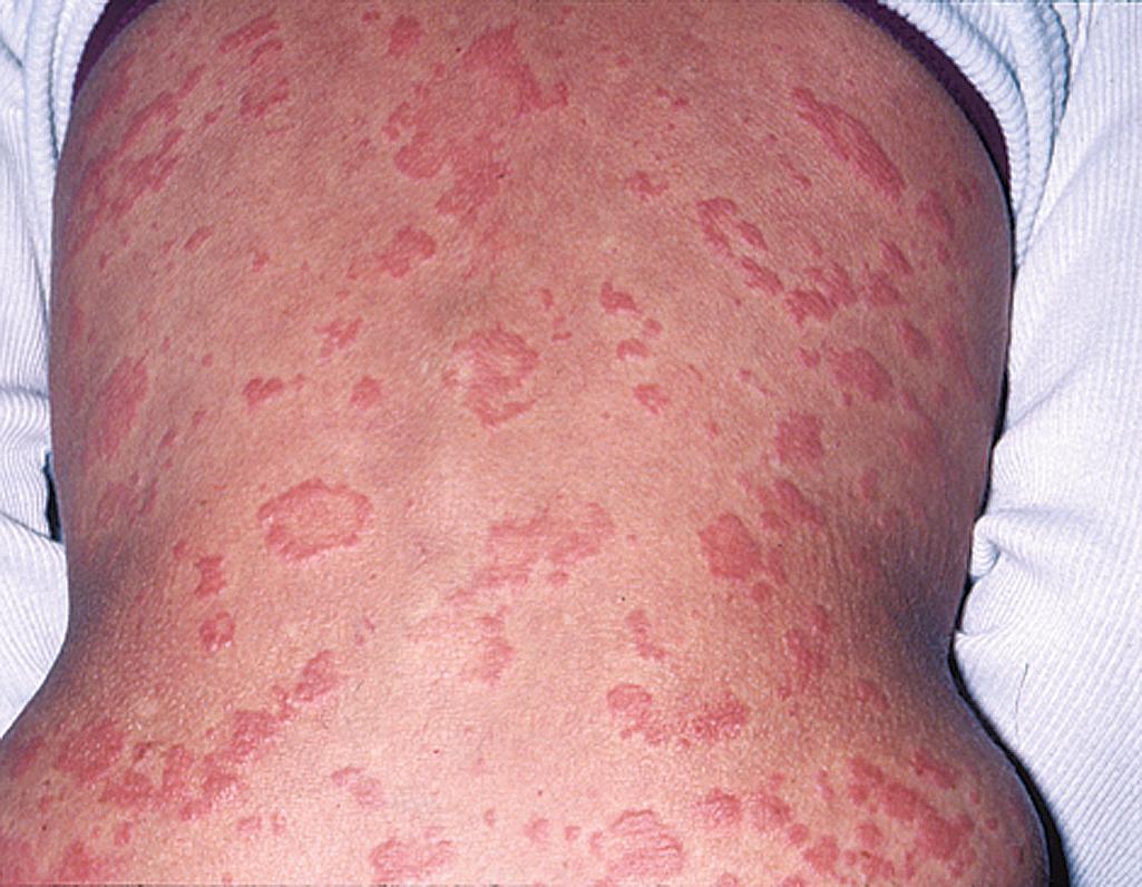 Fig. 54.3, Urticarial rash is the most common skin manifestation seen in Muckle-Wells syndrome.