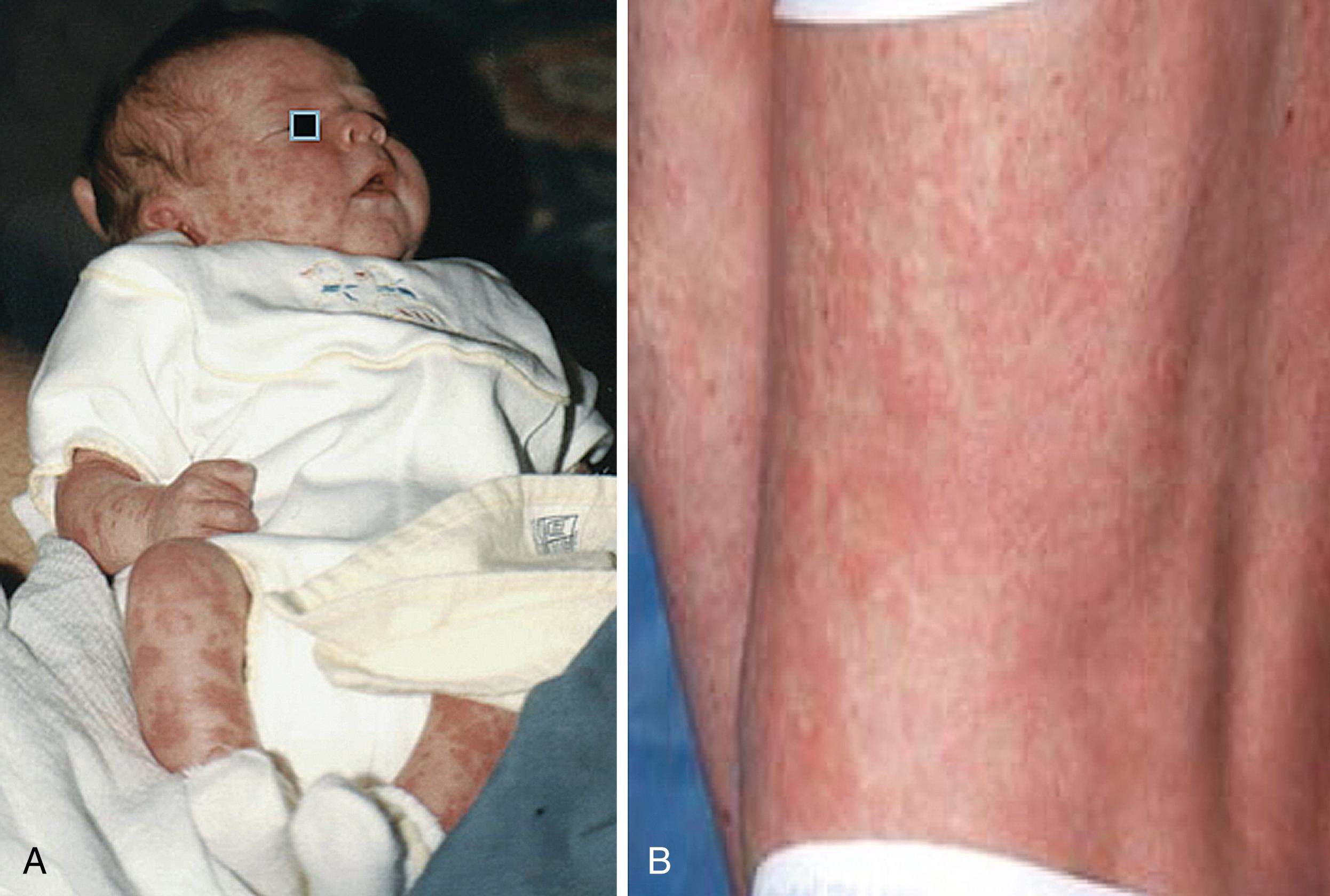 Fig. 54.4, Neonatal-onset multisystem inflammatory disorder . A, An urticaria-like rash is usually present at birth or during the first months of life. B, The rash is nonpruritic and papular.