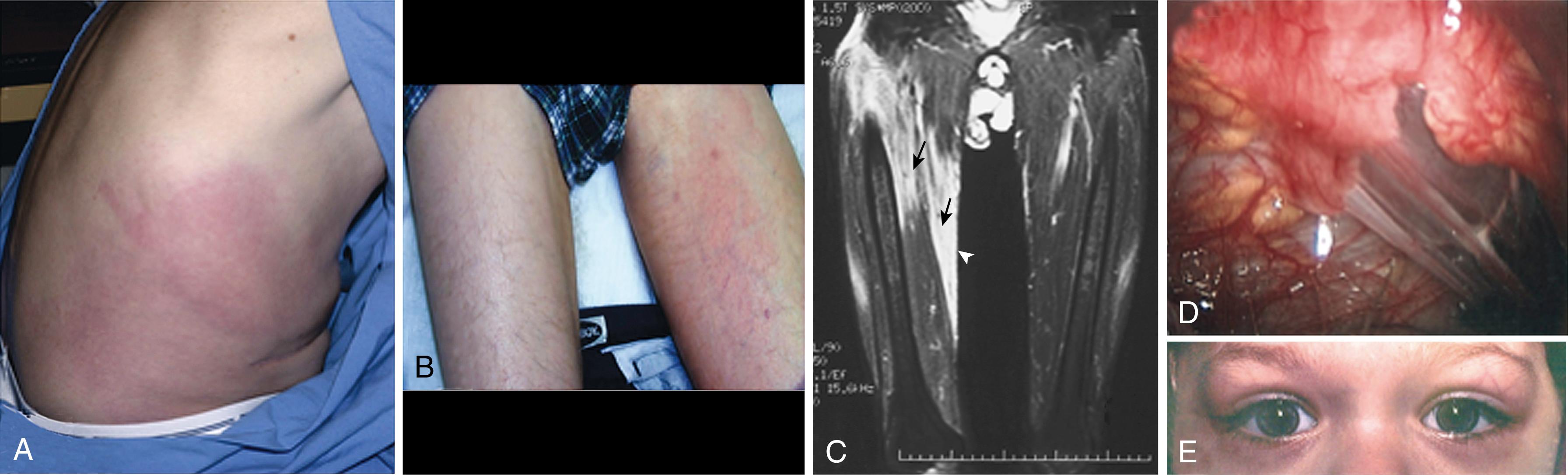 Fig. 54.6, Cutaneous findings associated with tumor necrosis factor receptor–associated periodic syndrome (TRAPS) may consist of macular areas of erythema on the torso (A) or on an extremity (B) . C, Sagittal views of the proximal thighs of a TRAPS patient demonstrating edematous changes within muscle compartments (black arrows) , here and extending to the skin (white arrows). D, Peritoneal inflammation can lead to adhesions. E, Periorbital edema is commonly observed in TRAPS patients during a flare.