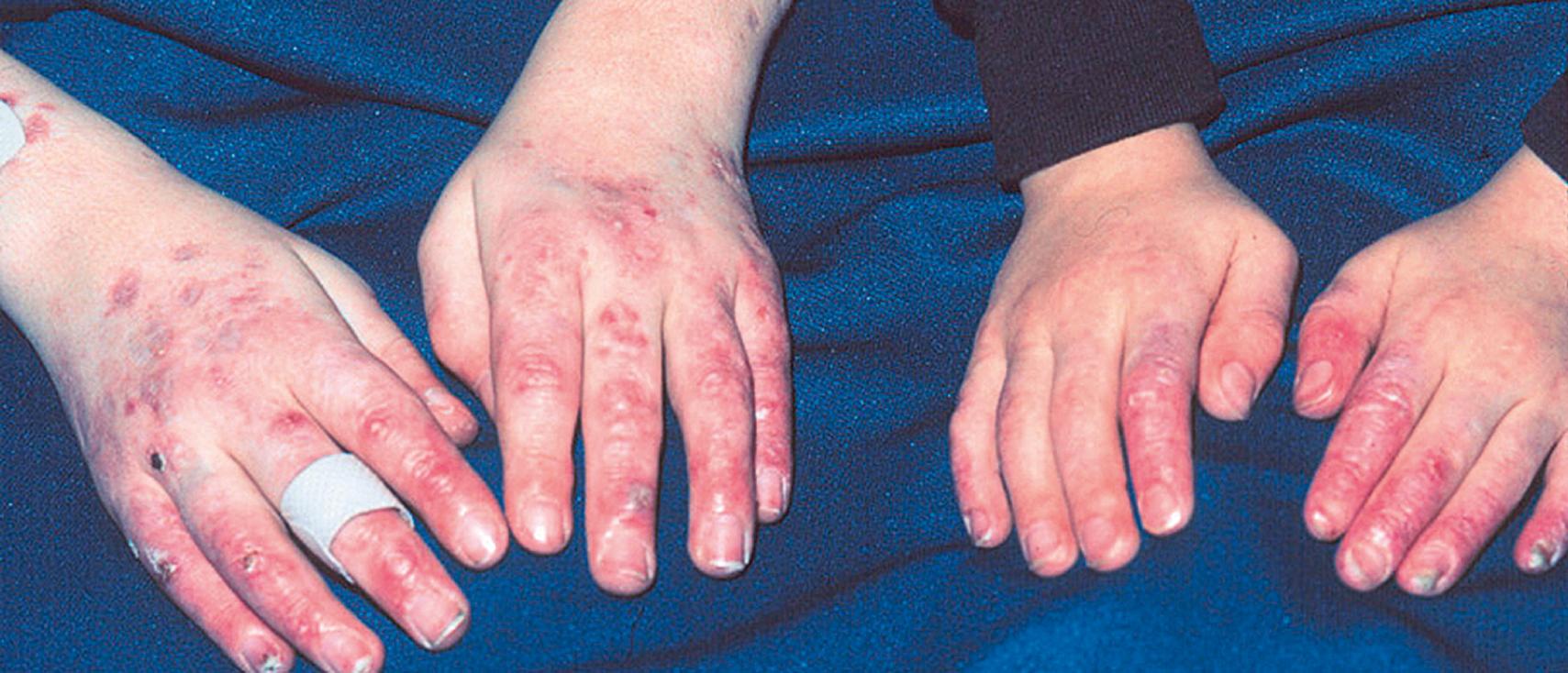 Fig. 54.8, Stimulator of interferon genes (STING)-associated vasculopathy with onset in infancy (SAVI) syndrome. These two unrelated boys both show the acral telangiectatic vasculopathy of SAVI syndrome. One of these boys died at 14 years of age because of his pulmonary disease.