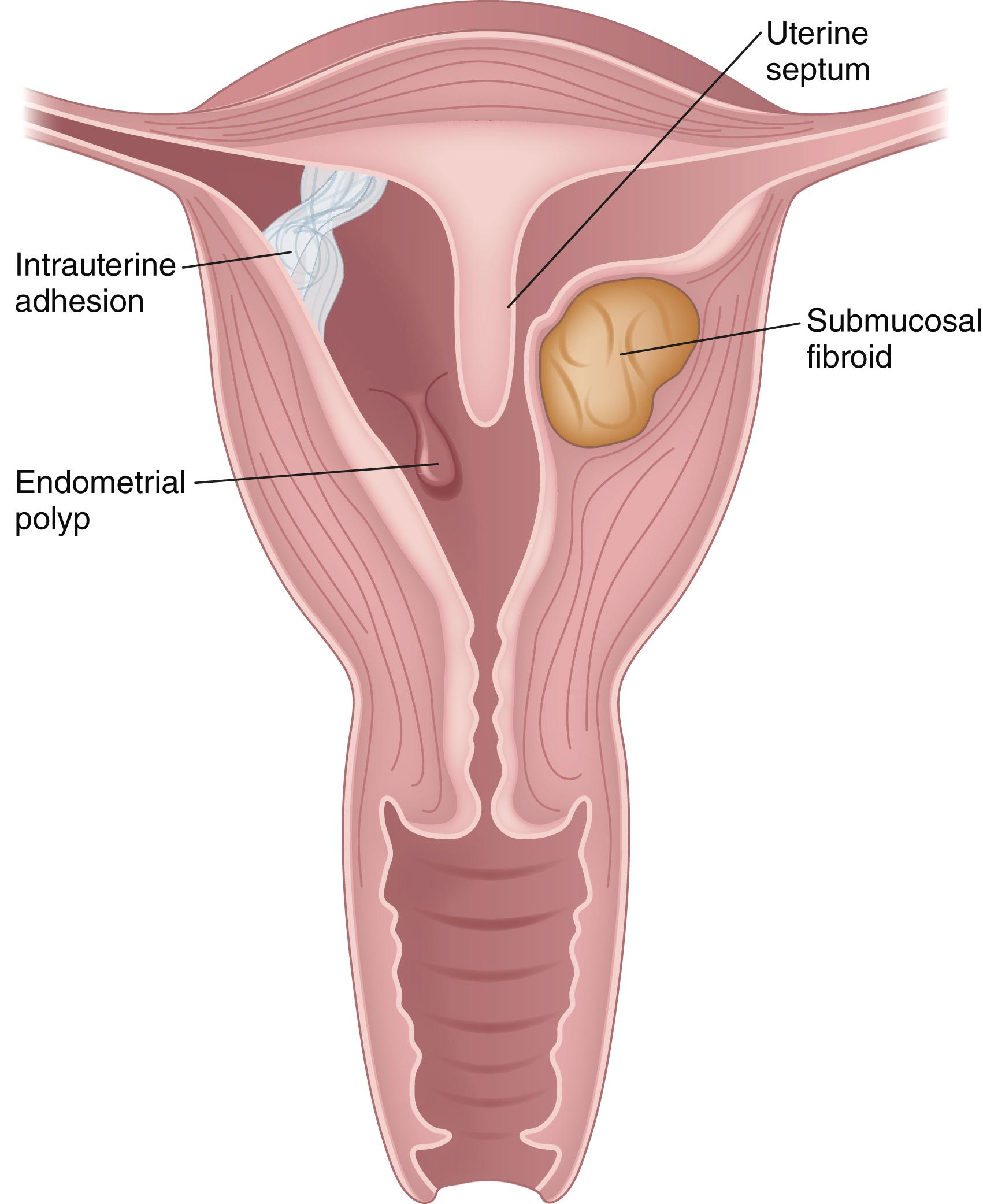 Fig. 28.4, Uterine pathologies in recurrent pregnancy loss.