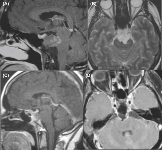 Figure 37.1, A 40-year-old woman presented with diplopia (left VI nerve paresis). The preoperative magnetic resonance imaging (MRI) showed a tumor of the midclivus (A, preop sagittal; B, preop axial). The patient underwent an extended transsphenoidal approach. Postoperative MRI (C, postop sagittal; D, postop axial) confirmed radical removal of the mass.