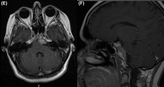 Figure 37.2, The patient received radiation therapy, but 2 years later, a new MRI depicted a recurrent tumor in the left petroclival junction, petrous apex, and cavernous sinus (E, preop axial; F, preop sagittal).