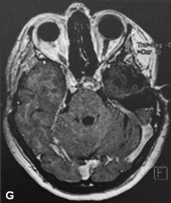 Figure 37.3, She underwent a left middle fossa approach with radical resection of the mass, as depicted by the postoperative MRI (G, postop axial).